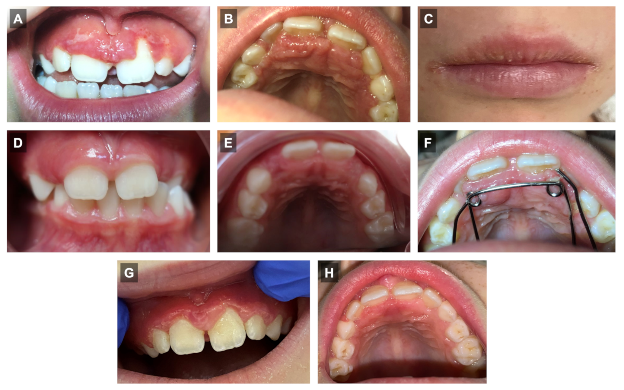 Orofacial Granulomatosis