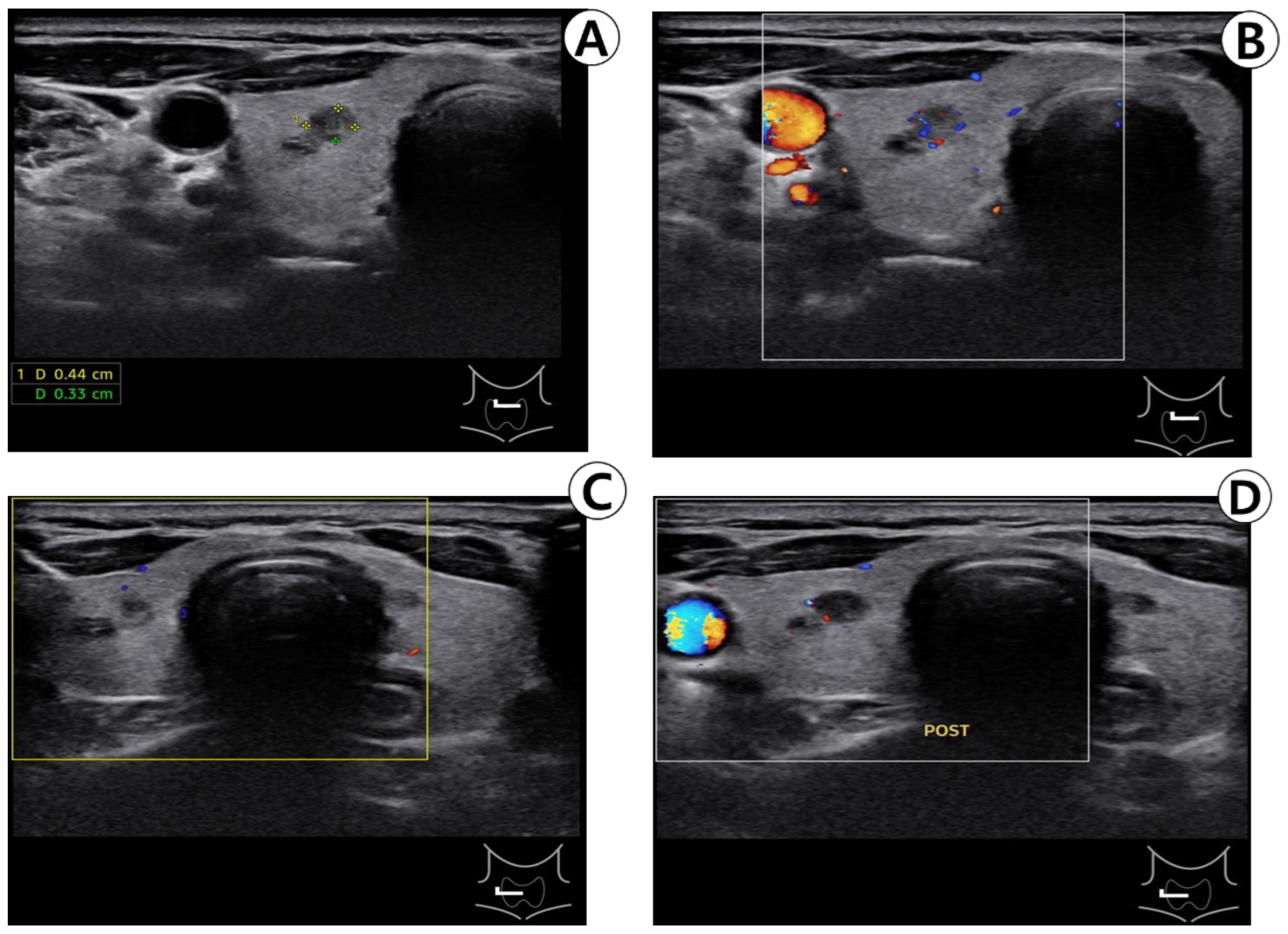 A Case of Diffuse Thyroid Hematoma after Ultrasound-Guided Fine Needle ...