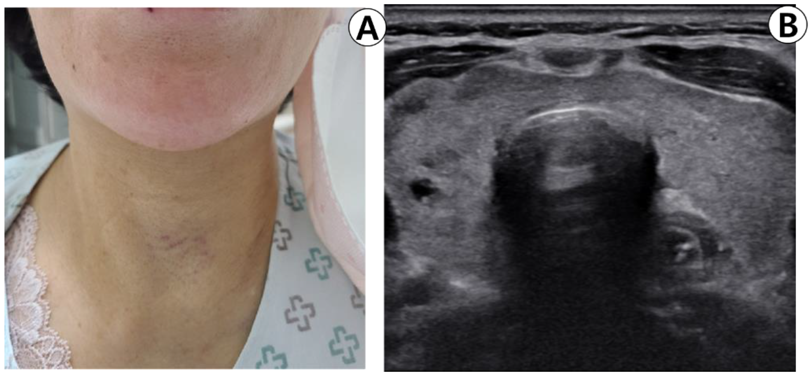 Is A Thyroid Biopsy Painful is-a-thyroid-biopsy-painful