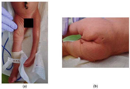Medicina | Free Full-Text | A Case of Neonate with Split Cord Malformation  Presenting with Hypoplasia of the Left Lower Extremity