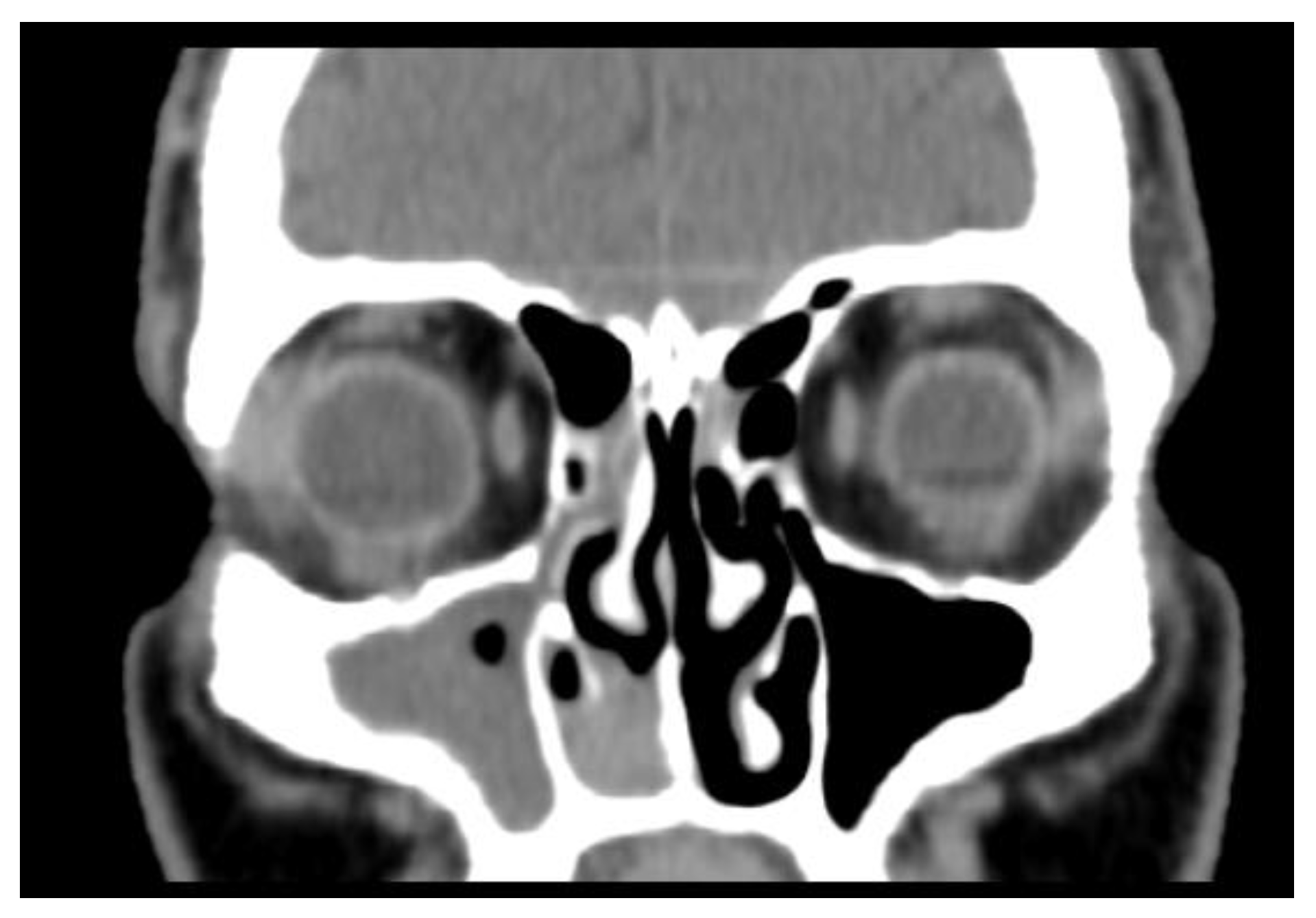 Olfactory Neuroblastoma—A Challenging Fine Line between