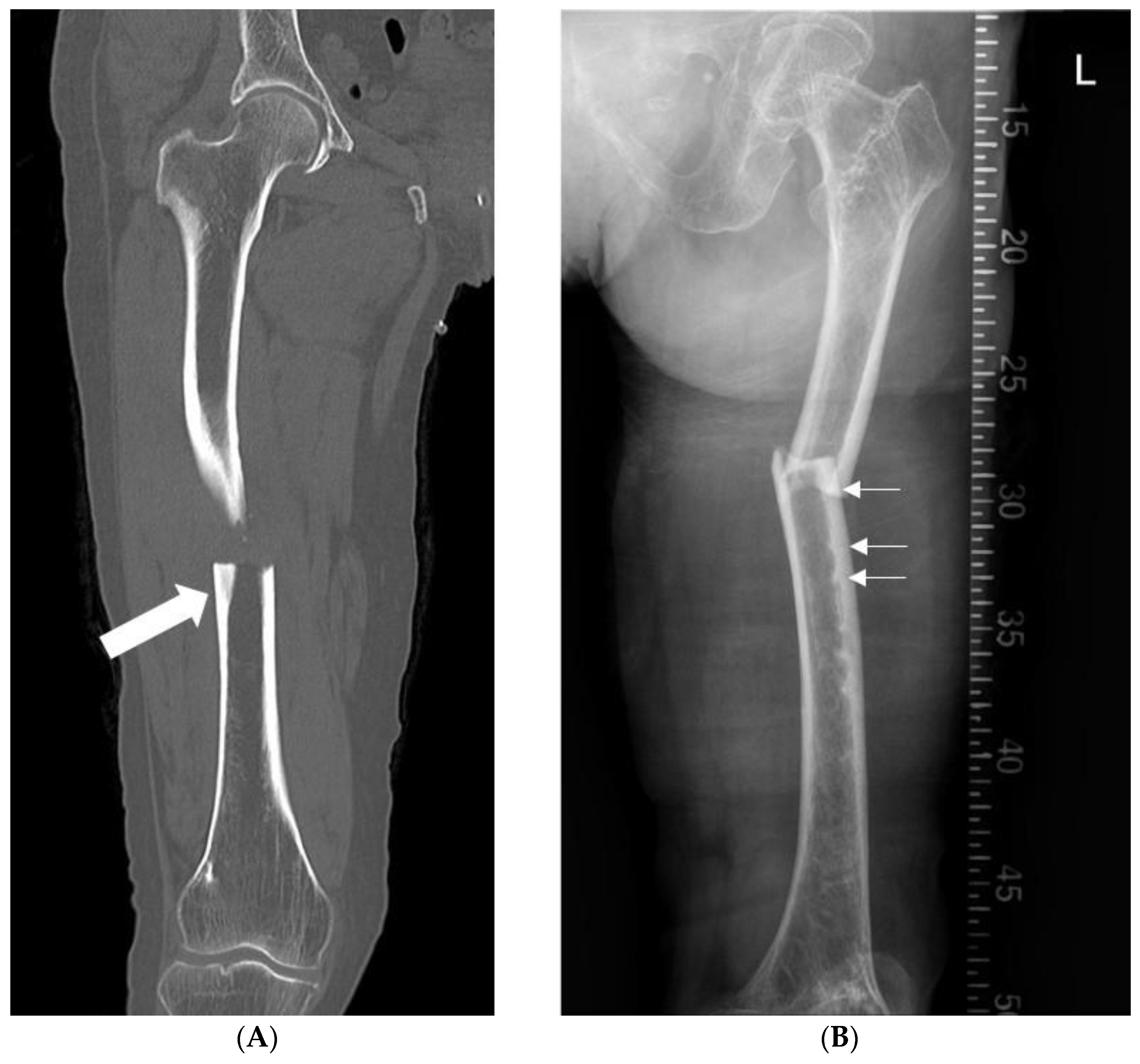 Retrograde Femoral Nail (Implant 420) - orthopaediclist.com