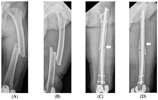 Hana Retrograde IM Femoral Nailing: Supine with Unilateral Skin Traction