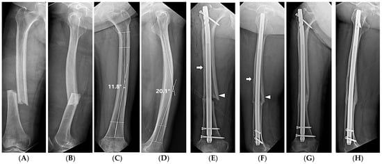 Outcomes of intramedullary nailing for open fractures of the tibial shaft