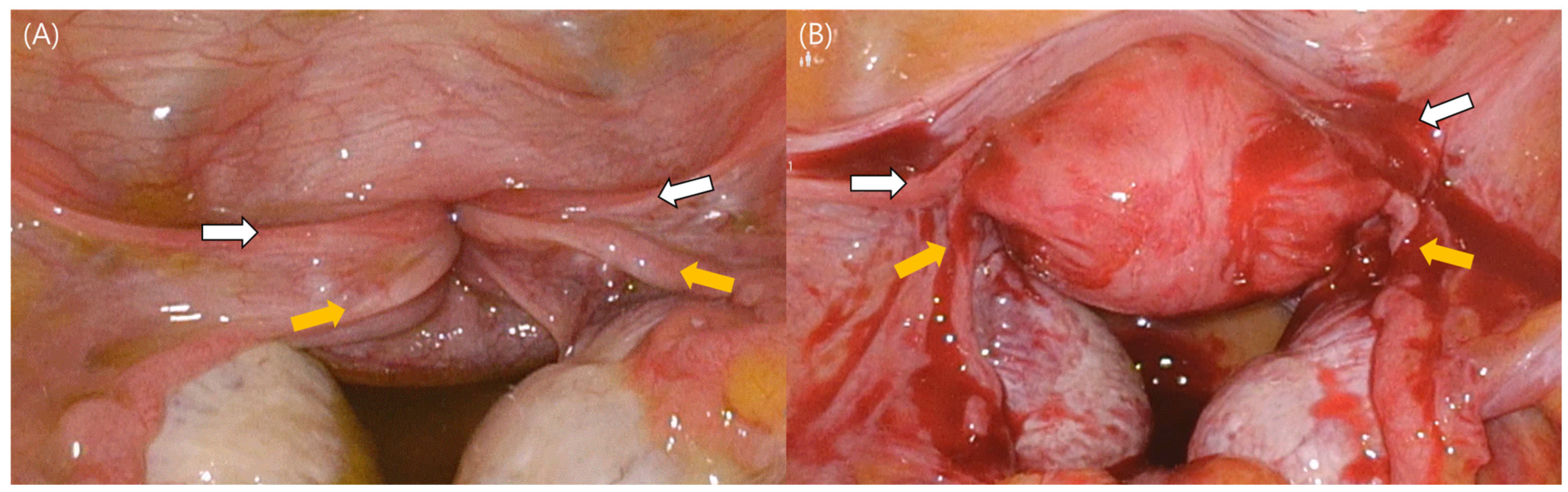 Medicina | Free Full-Text | A Rare Case Report of Successful  Laparoscopy-Guided Reduction of Non-Puerperal Uterine Inversion