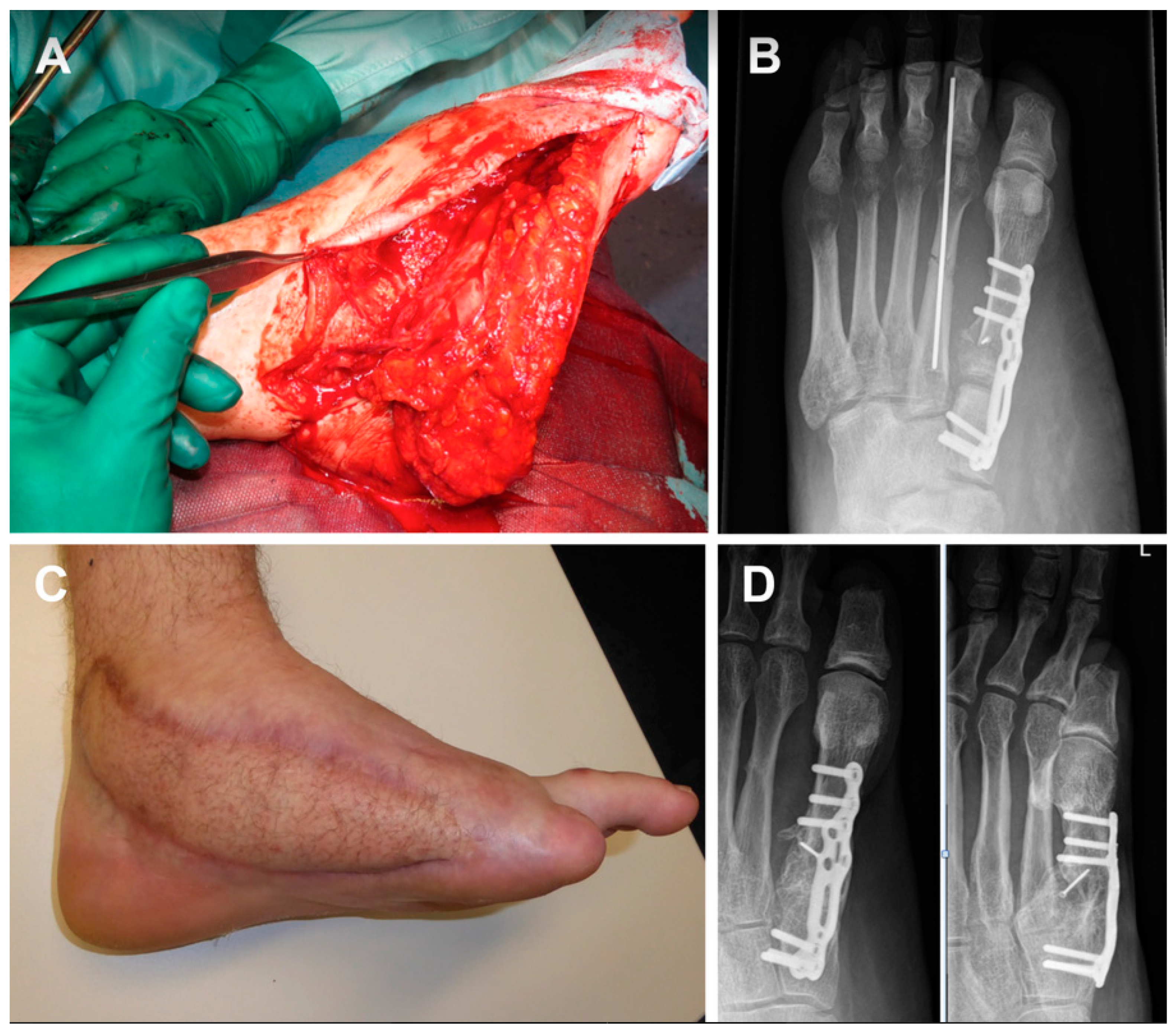 Medicina | Free Full-Text | Combined Free Flaps for Optimal Orthoplastic  Lower Limb Reconstruction: A Retrospective Series