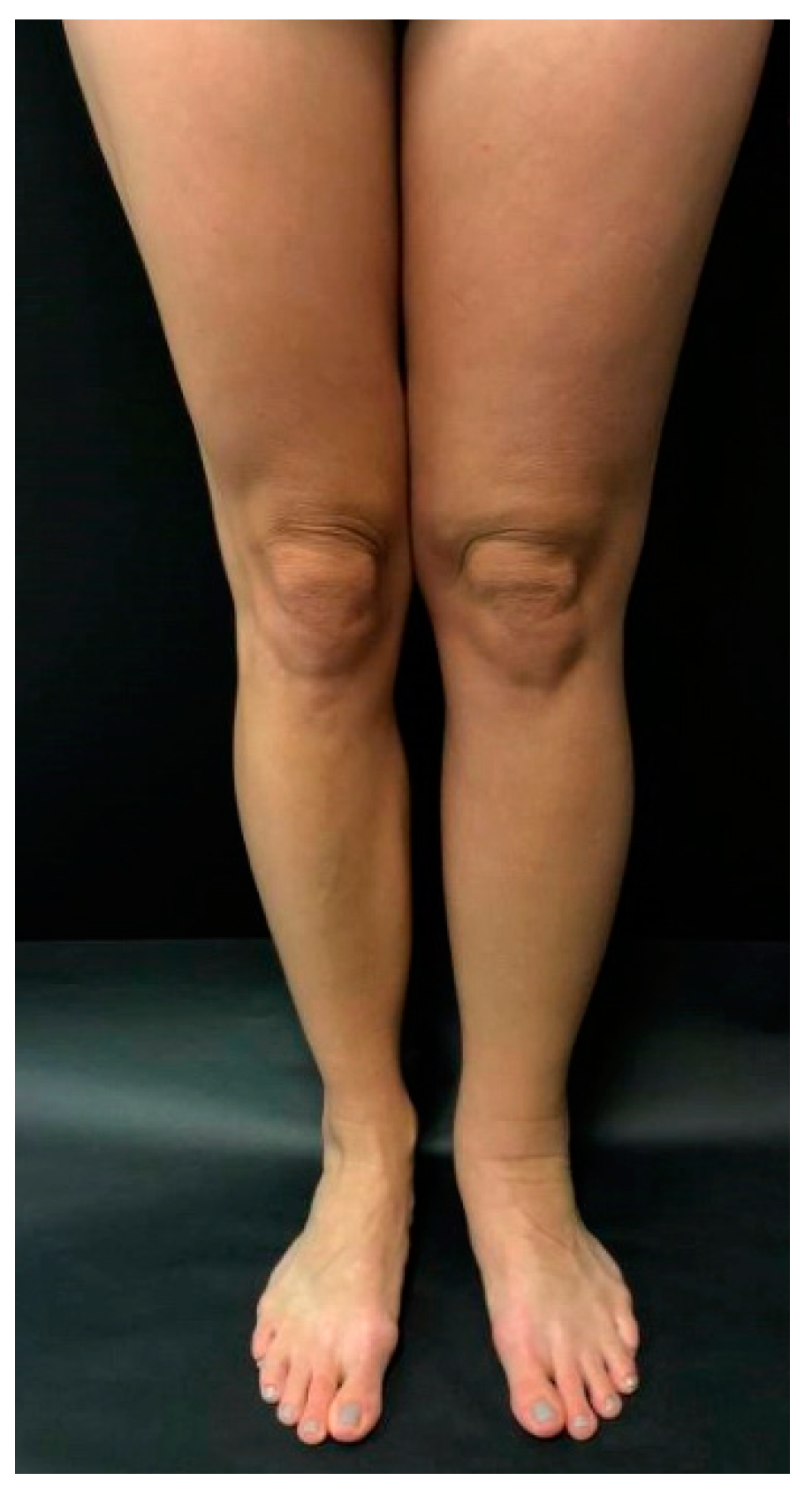 Medicina | Free Full-Text | Current Concepts in the Management of Primary  Lymphedema