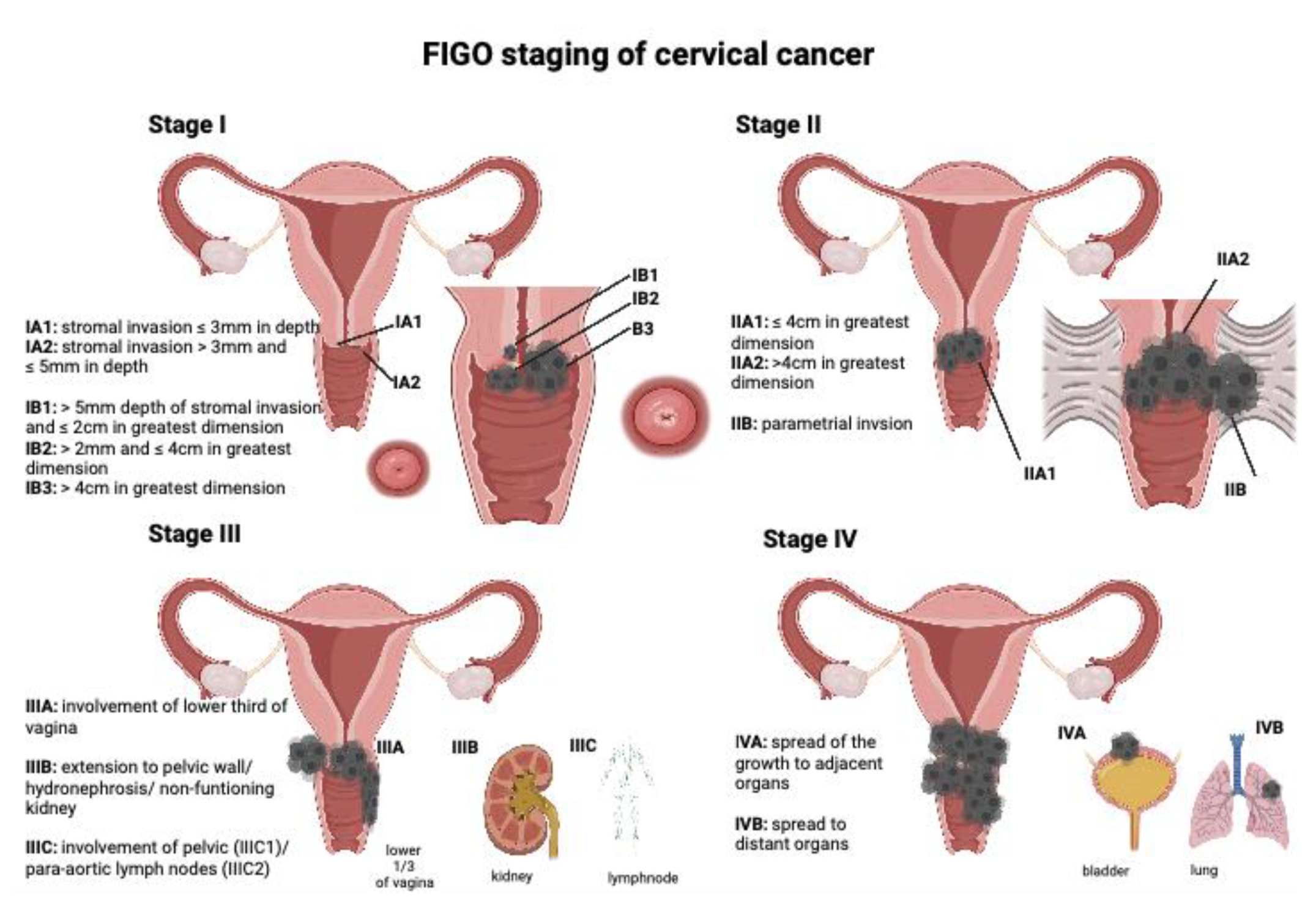 Cervical Cancer