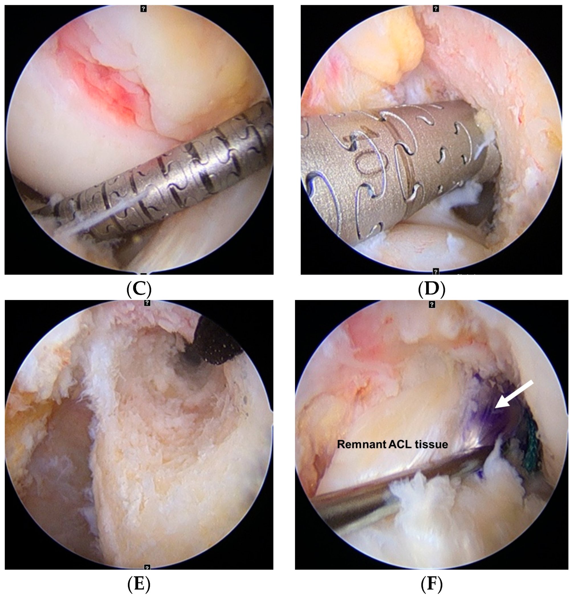 Arthroscopic picture of left knee revealing (a) bulky anterior cruciate