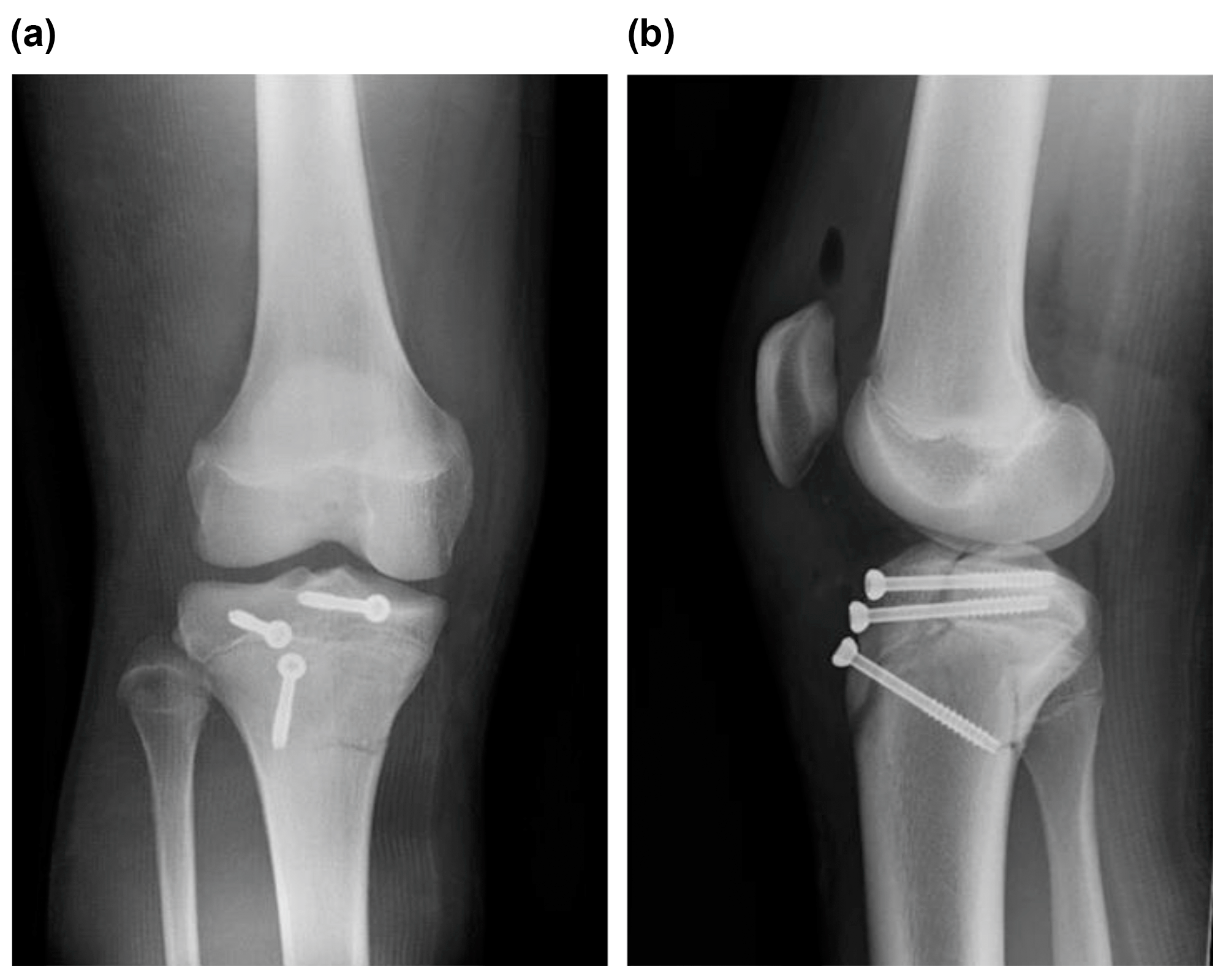 Medicina Free Full Text Type V Tibial Tubercle Avulsion Fracture