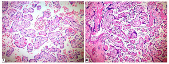 ［入手困難］ PLACENTA／CONDEMNED Investigation of CD56, ADAM17 and FGF21 Expressions in the