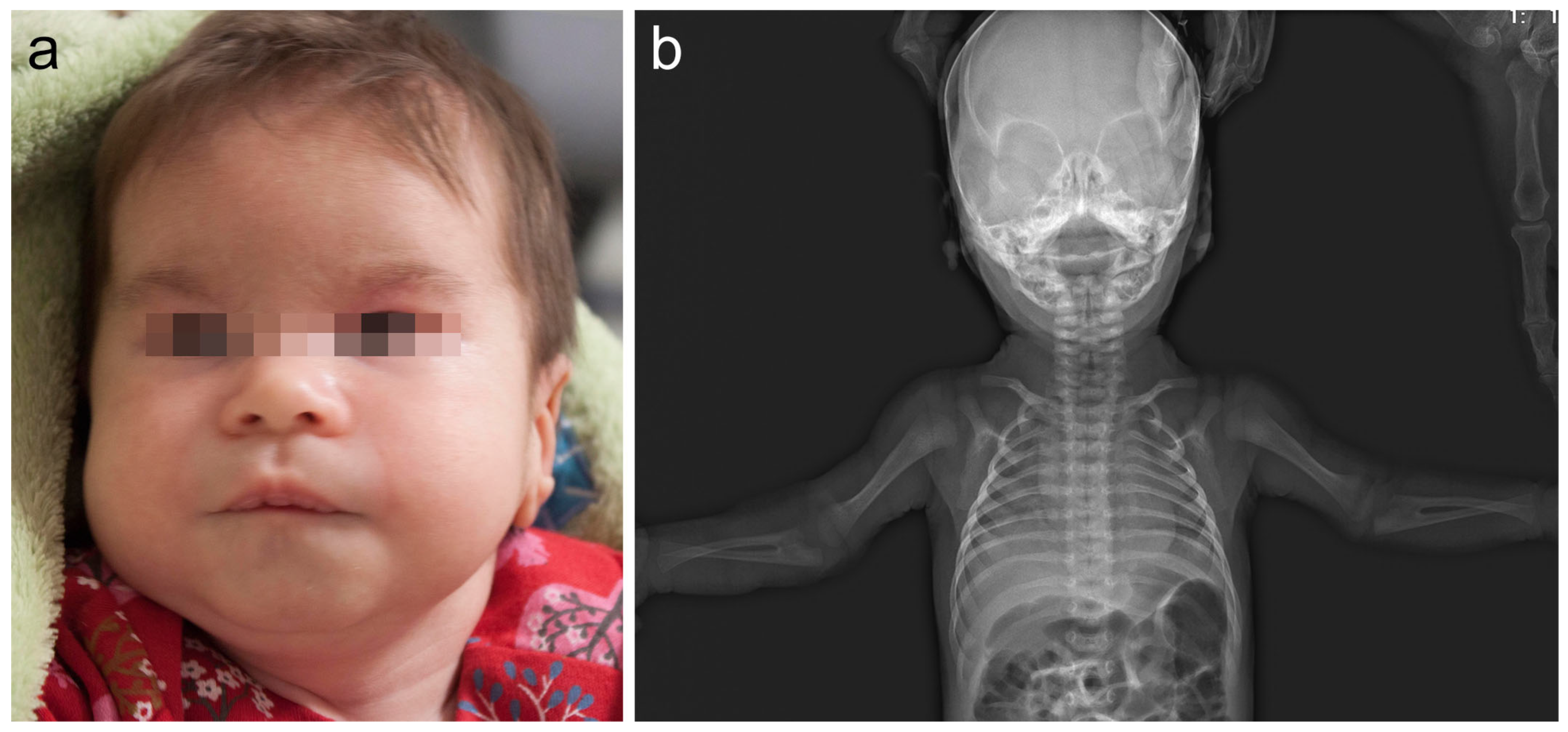 A De Novo 8q22.2q22.3 Interstitial Microdeletion in a Girl