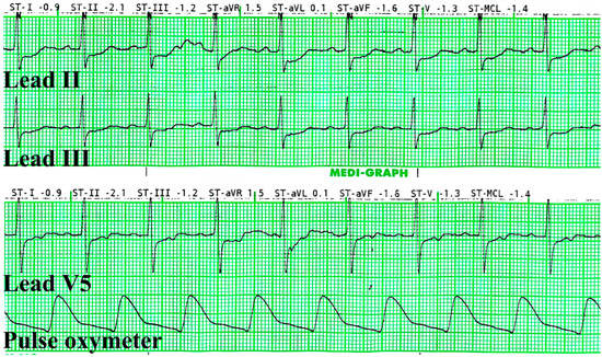 Asymptomatic Type 2 Perioperative Myocardial Infarction Detected before ...