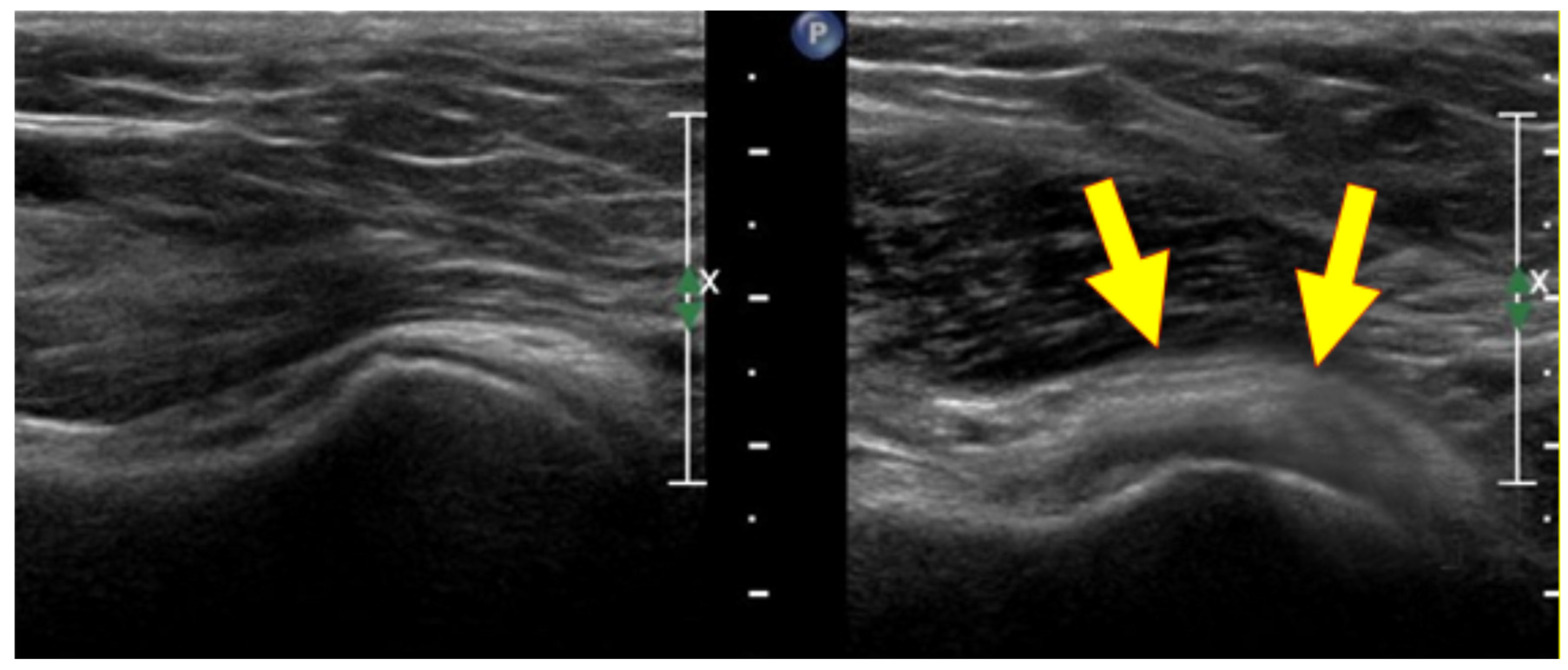 Medicina Free FullText UltrasoundGuided Infiltrative Treatment Associated with Early