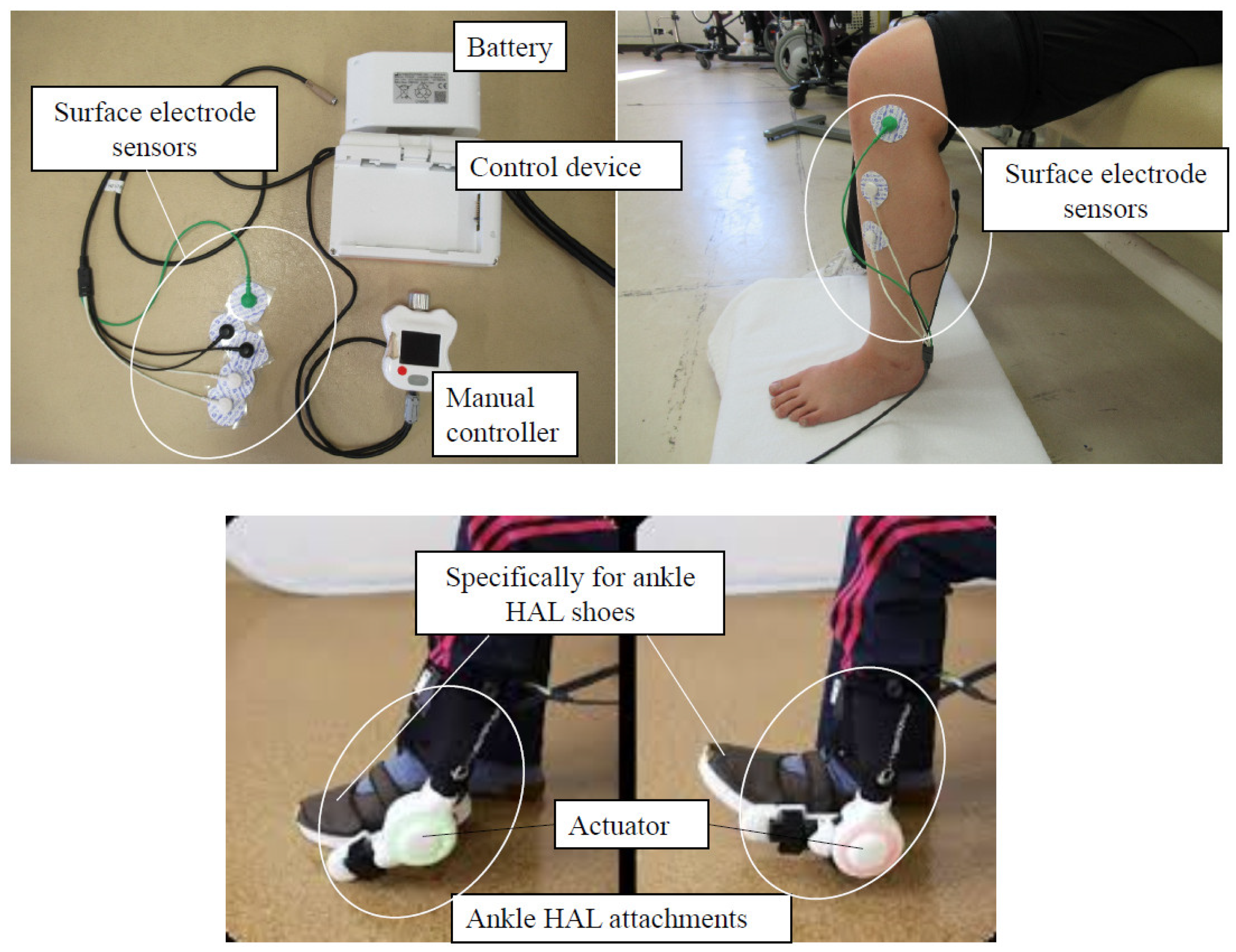 Peripheral Nerve Stimulation Video