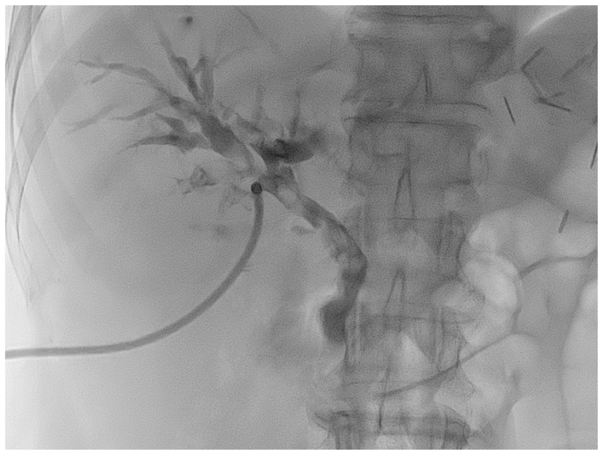 A Case of Biliary Cast Syndrome with Cholangiocarcinoma-like Lesion in ...
