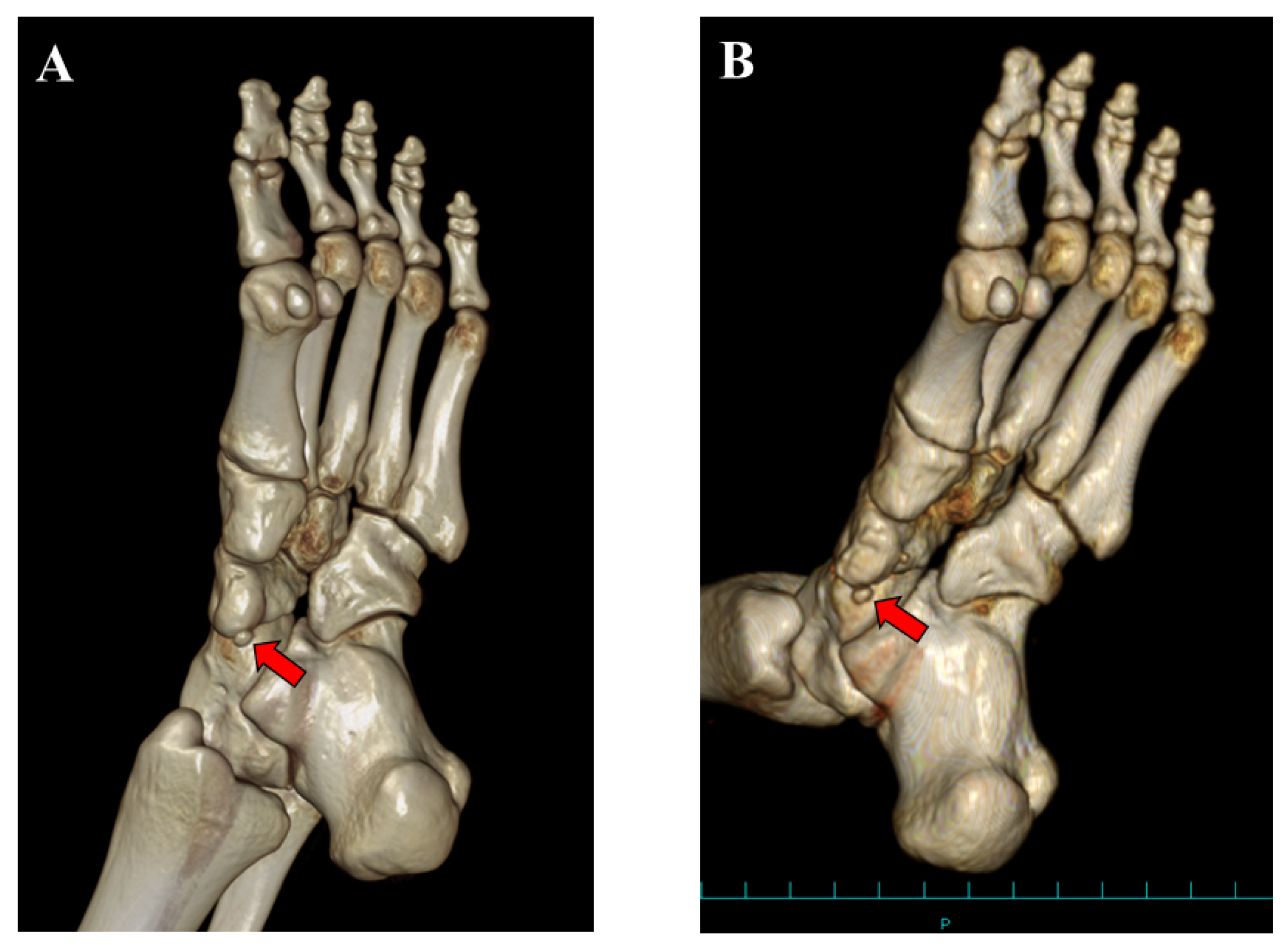Medicina Free FullText Is the Small Ossicle of Type 1 Accessory