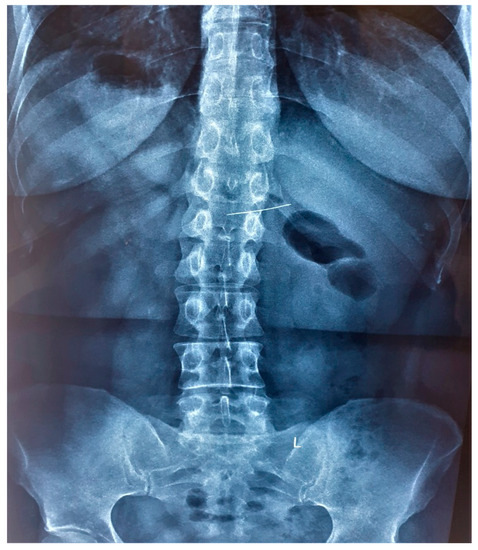 Accidental Sewing Pin Ingestion by a Tailor: A Case Report