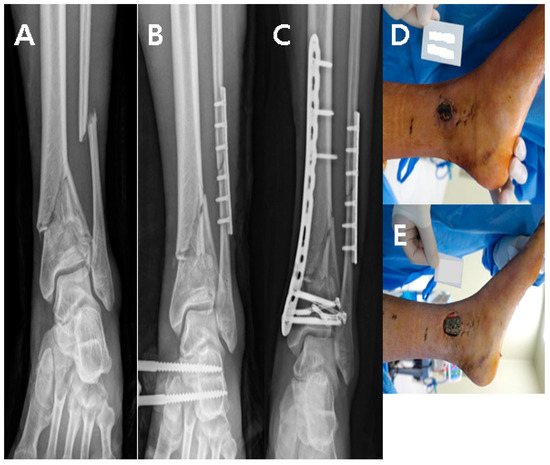 Distal Tibia Plate Surgical Technique