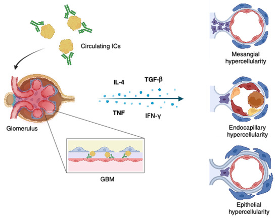 Understanding Lupus Glomerulonephritis