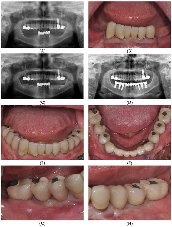 Medicina Free FullText Technical Note on Vestibuloplasty around