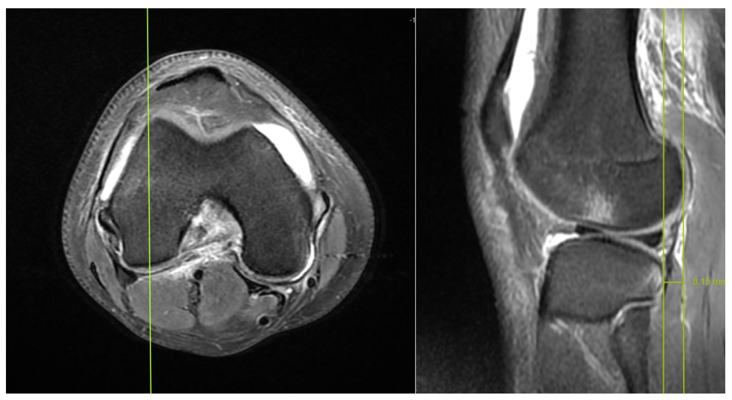 Medicina Free FullText Does Rotation and Anterior Translation