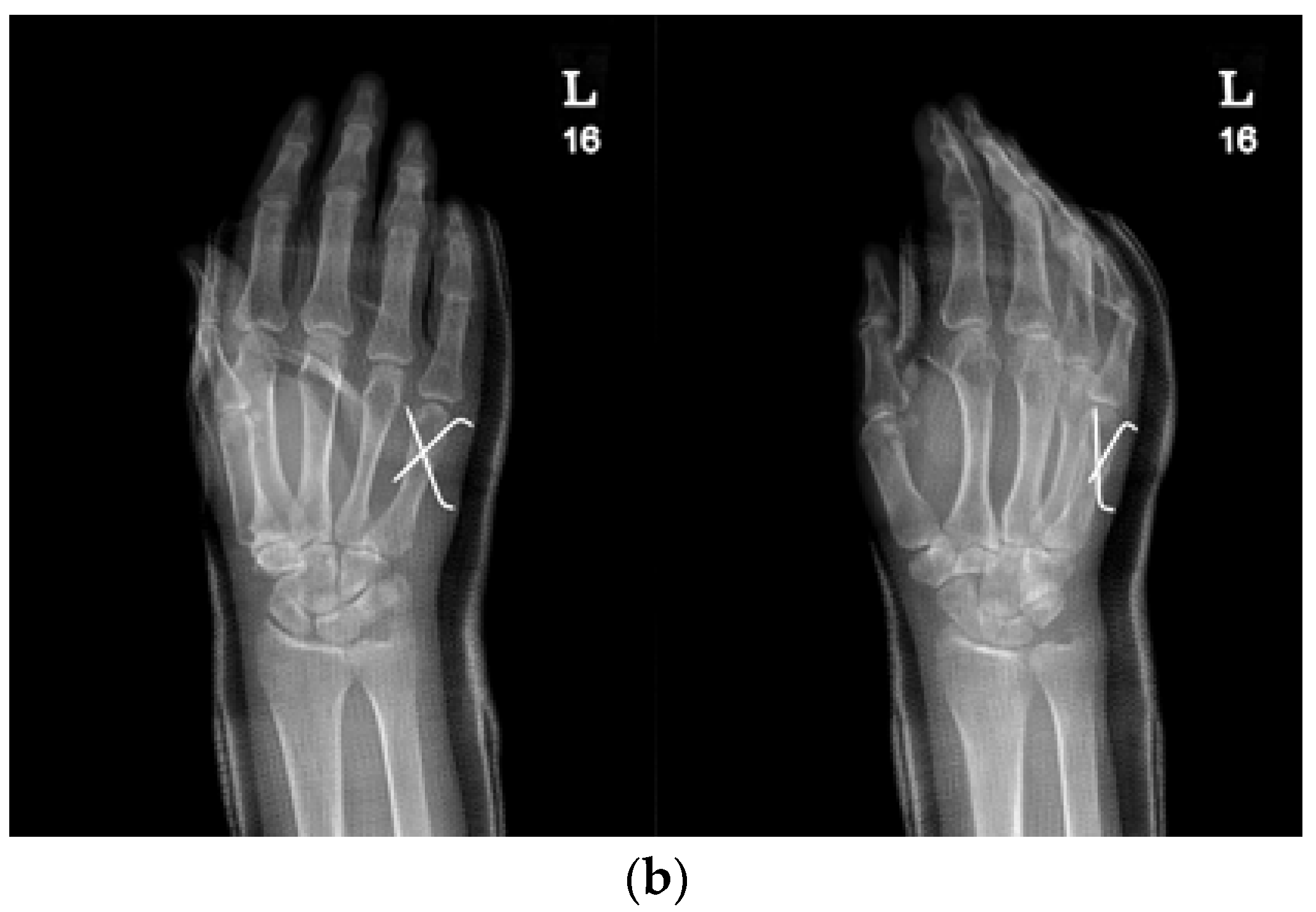 Boxers fracture pins