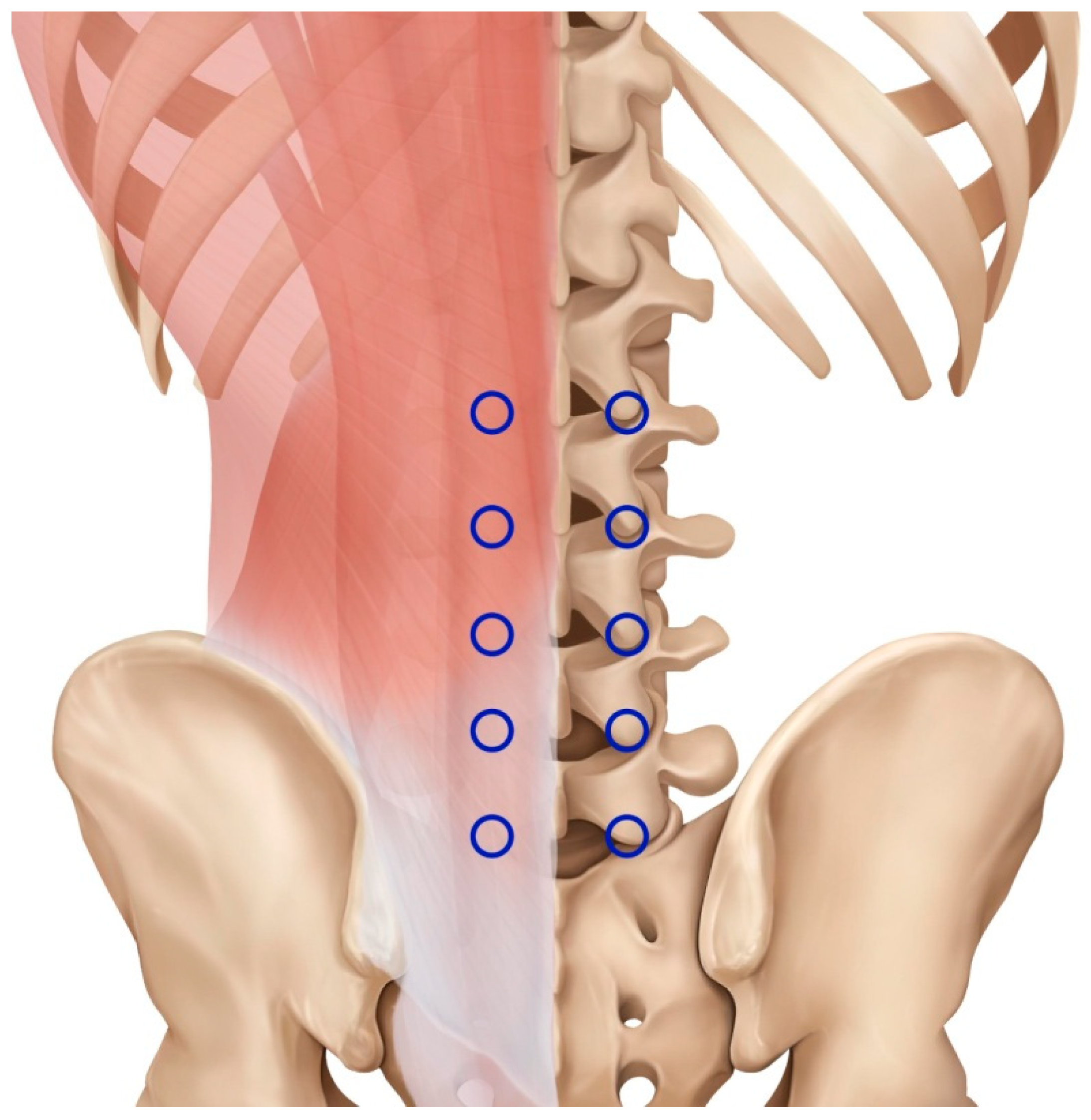 Effectiveness of Acupotomy Combined with Epidural Steroid