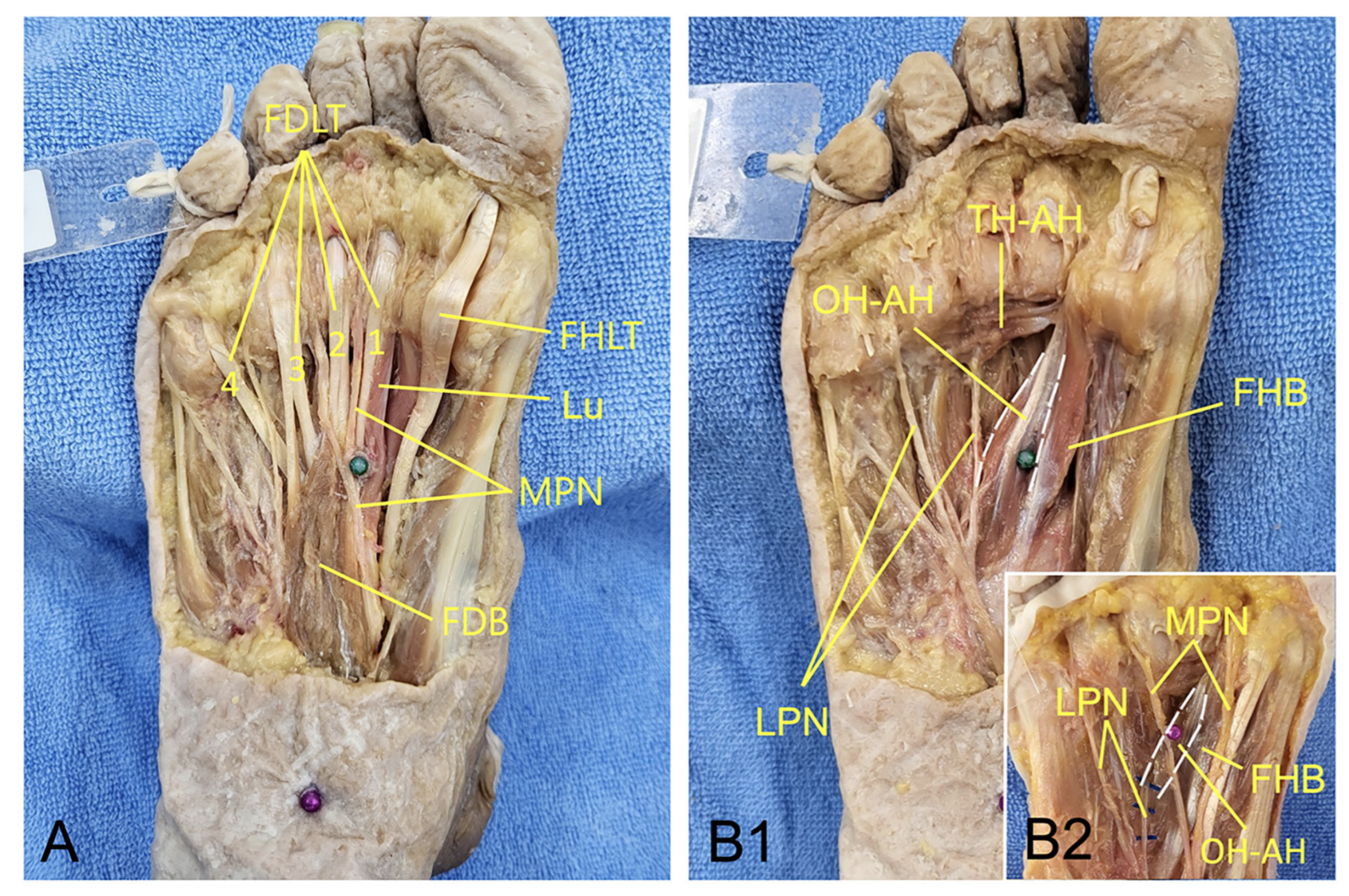 Anatomical Exploration of the KI1 Acupoint: Implications for