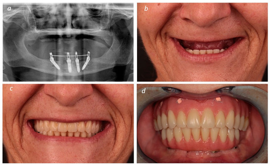 A New Full Digital Workflow for Fixed Prosthetic Rehabilitation of