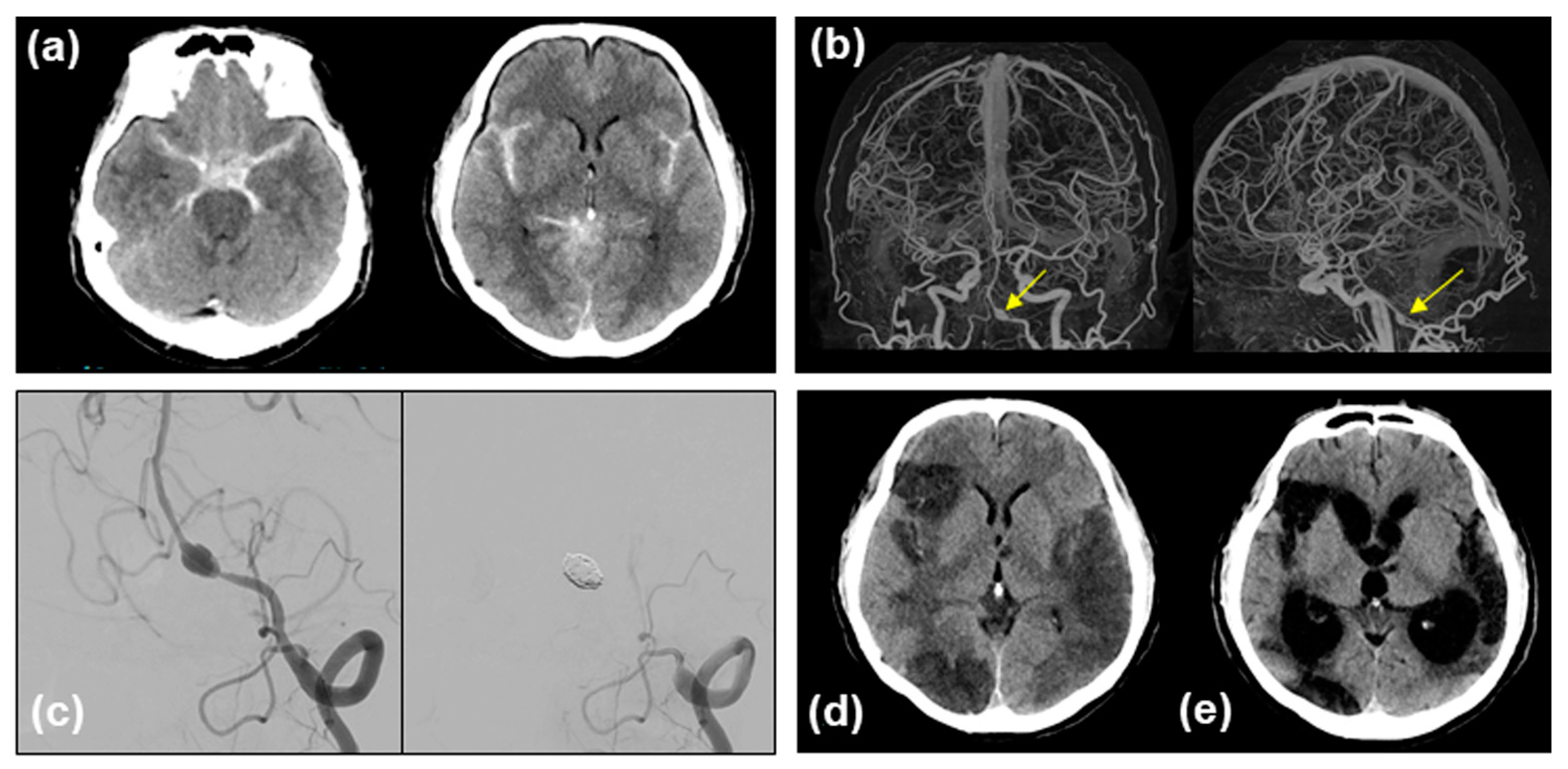 Symptomatic Vasospasm Refractory to Clazosentan after Subarachnoid ...