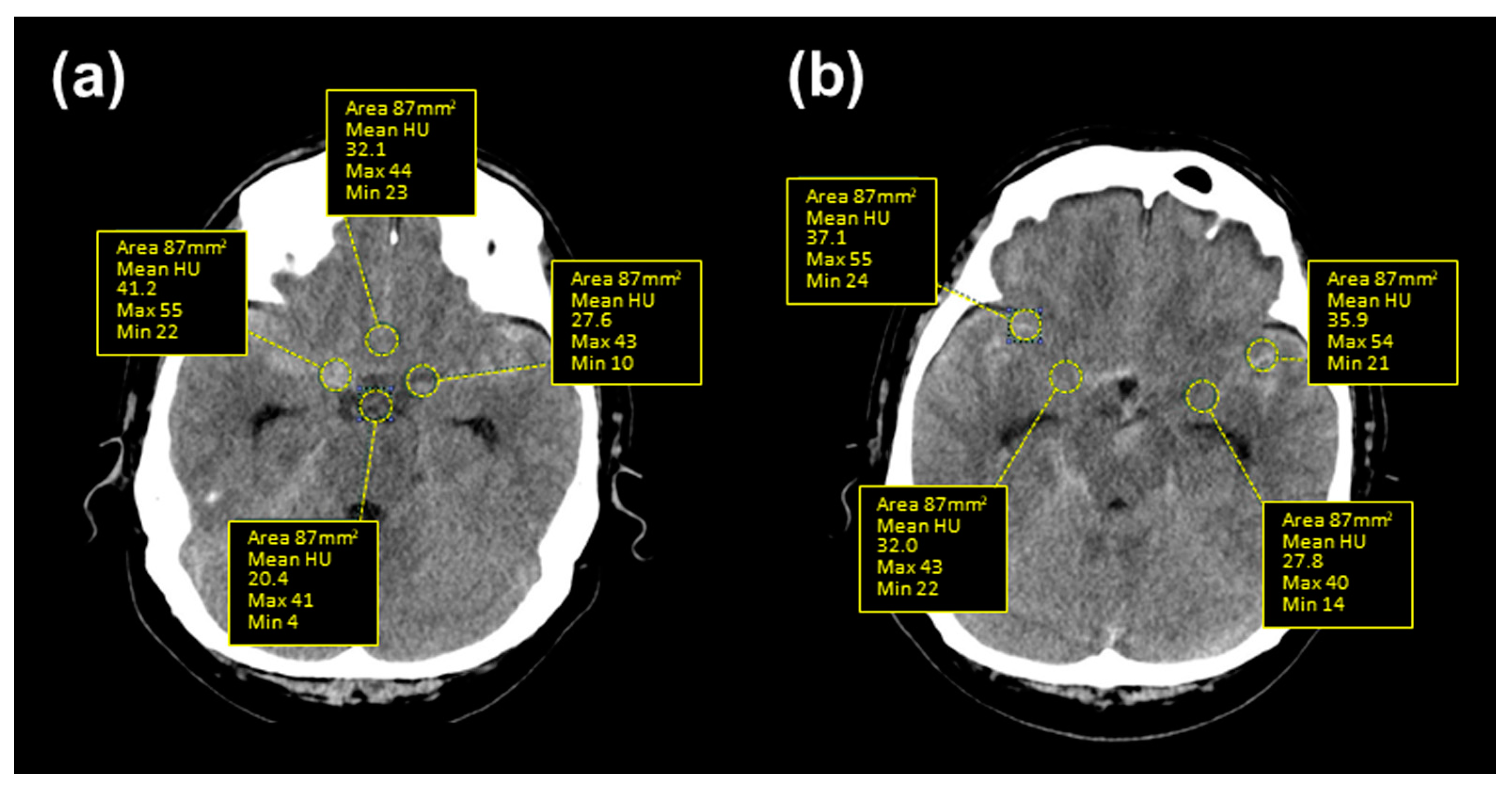 Symptomatic Vasospasm Refractory to Clazosentan after Subarachnoid ...