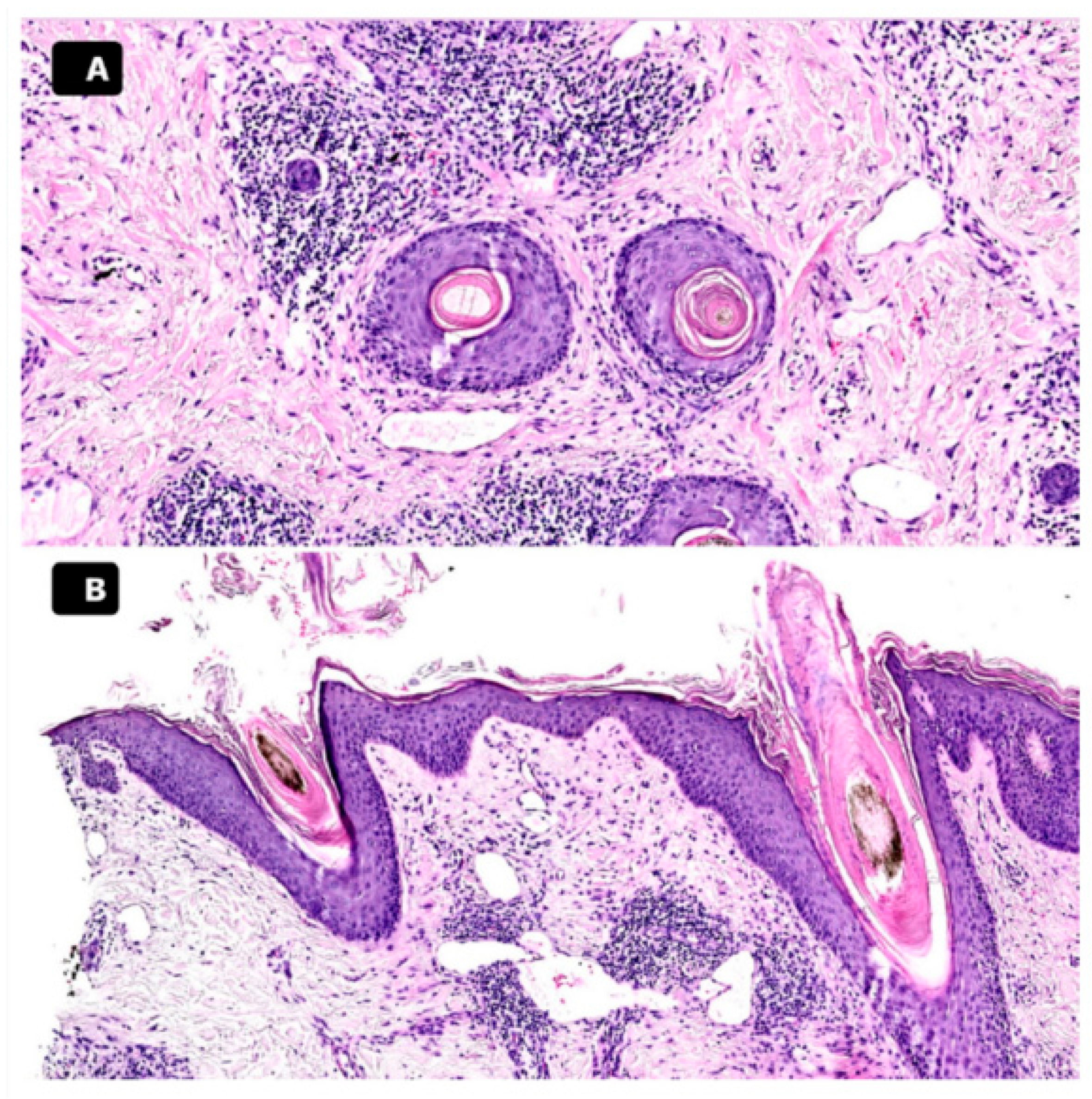 Uncommon Presentation of Pityriasis Rubra Pilaris of the