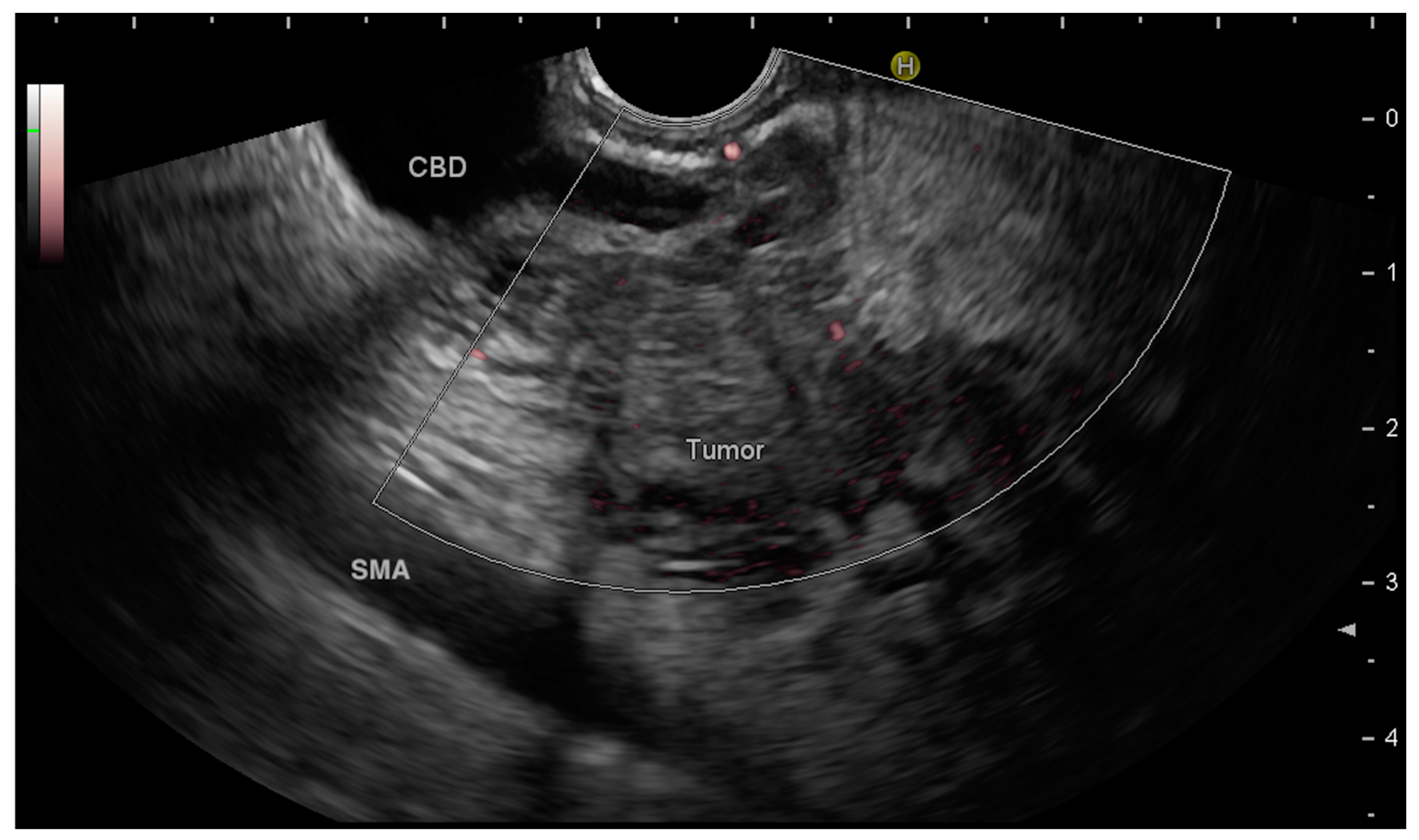 Endoscopic Ultrasound-Guided Pancreatic Tissue Sampling: Lesion 