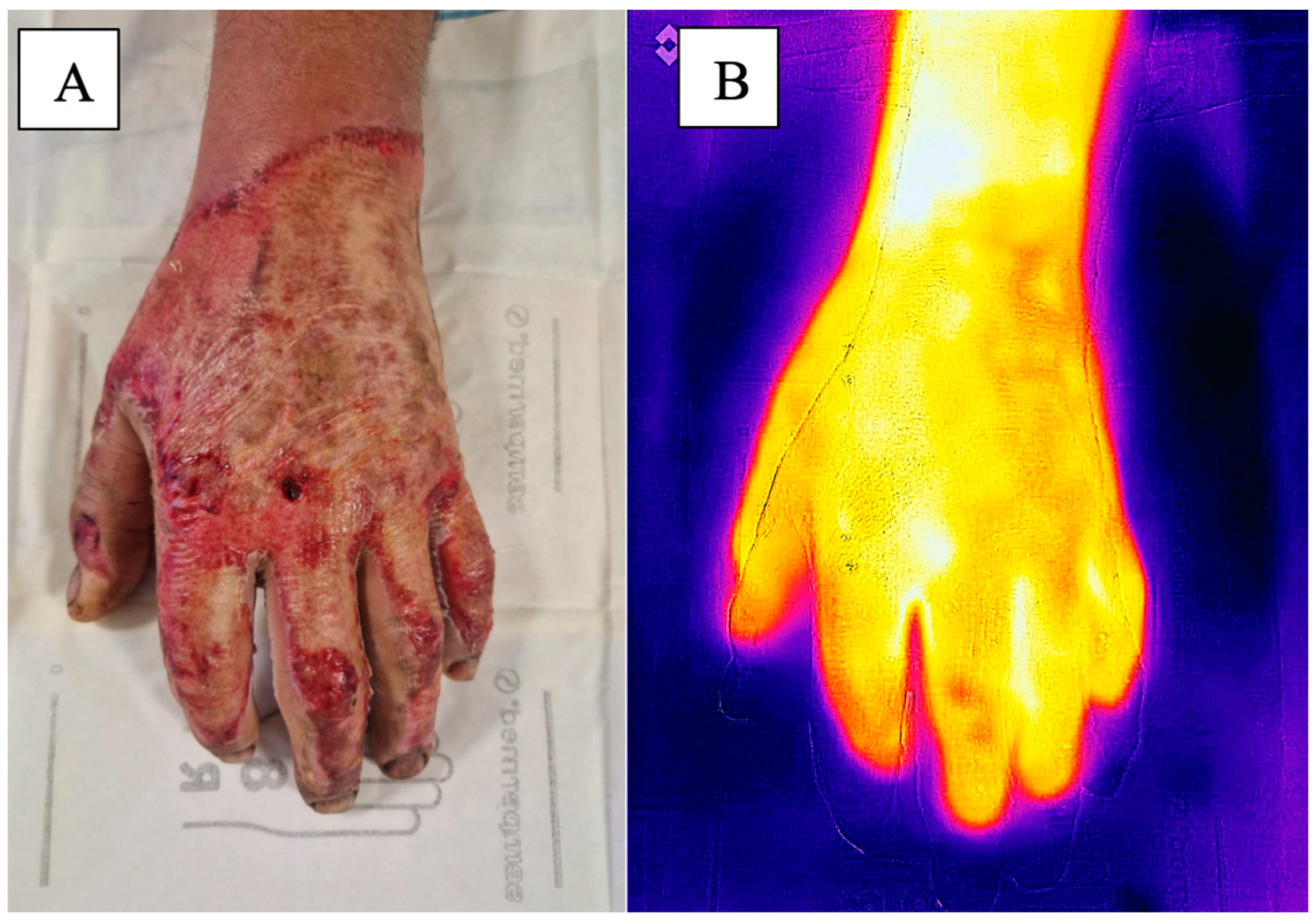 Burns Algorithm - Manual of Medicine