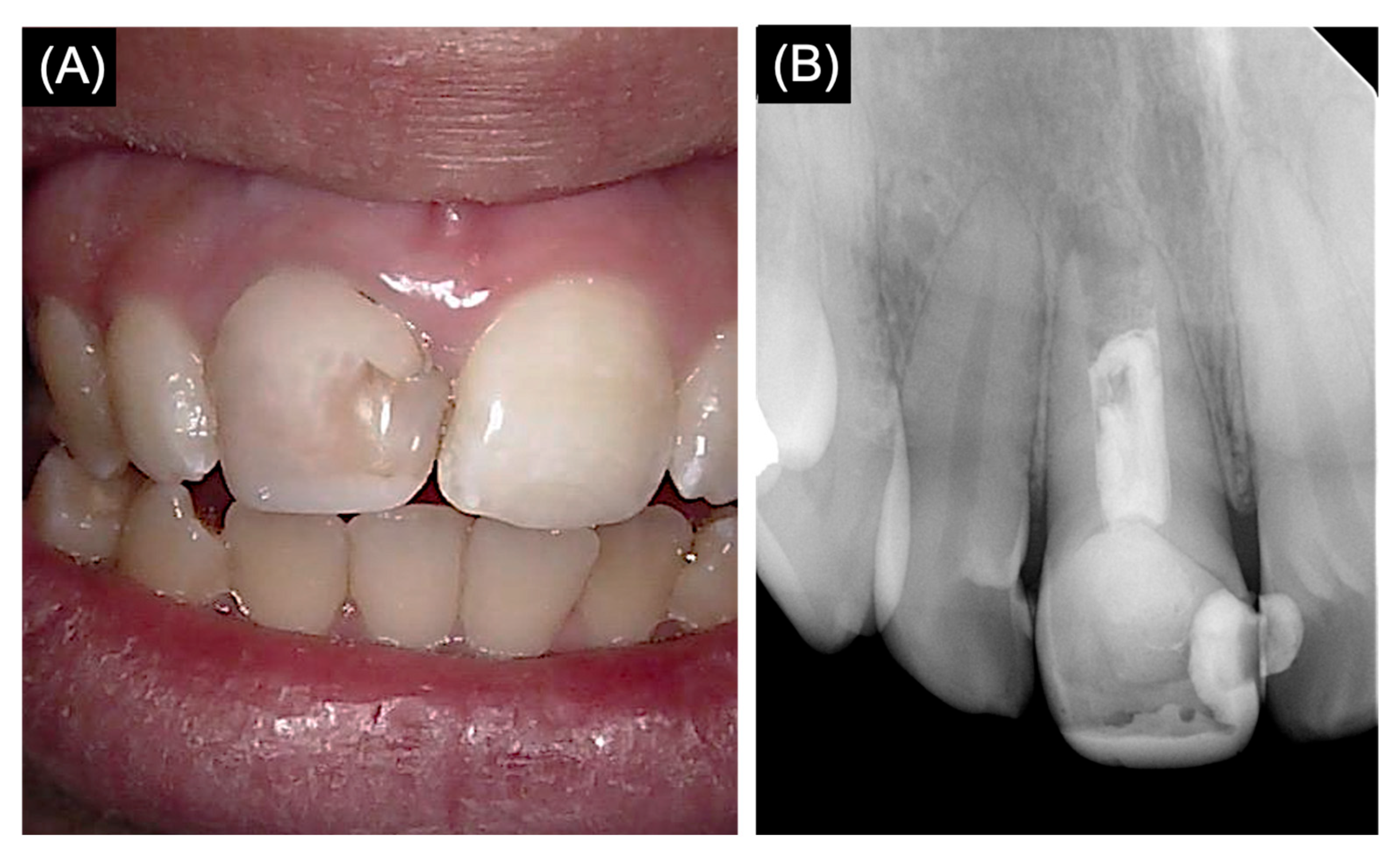 Apexification of an Endodontically Failed Permanent Tooth