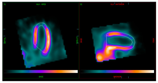 Comparative Analysis of Cardiac SPECT Myocardial Perfusion Imaging ...