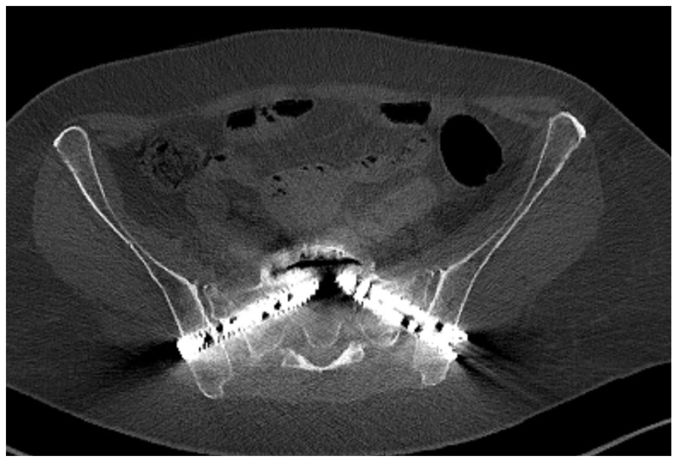 Preoperative 3D-Planned S1 Corridors Transferred into 2D