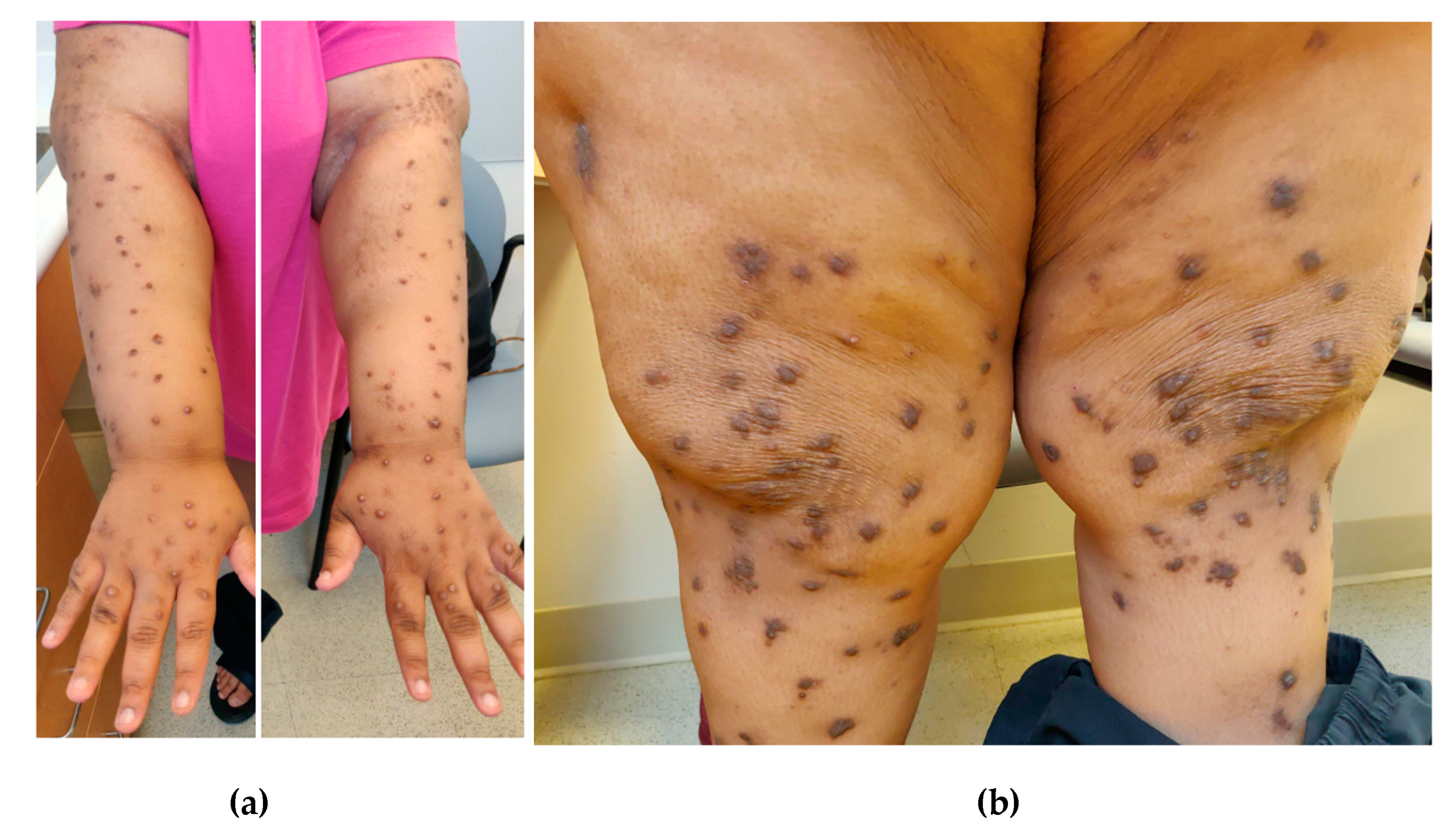 What Is Prurigo Nodularis? Pictures, Causes, Treatment