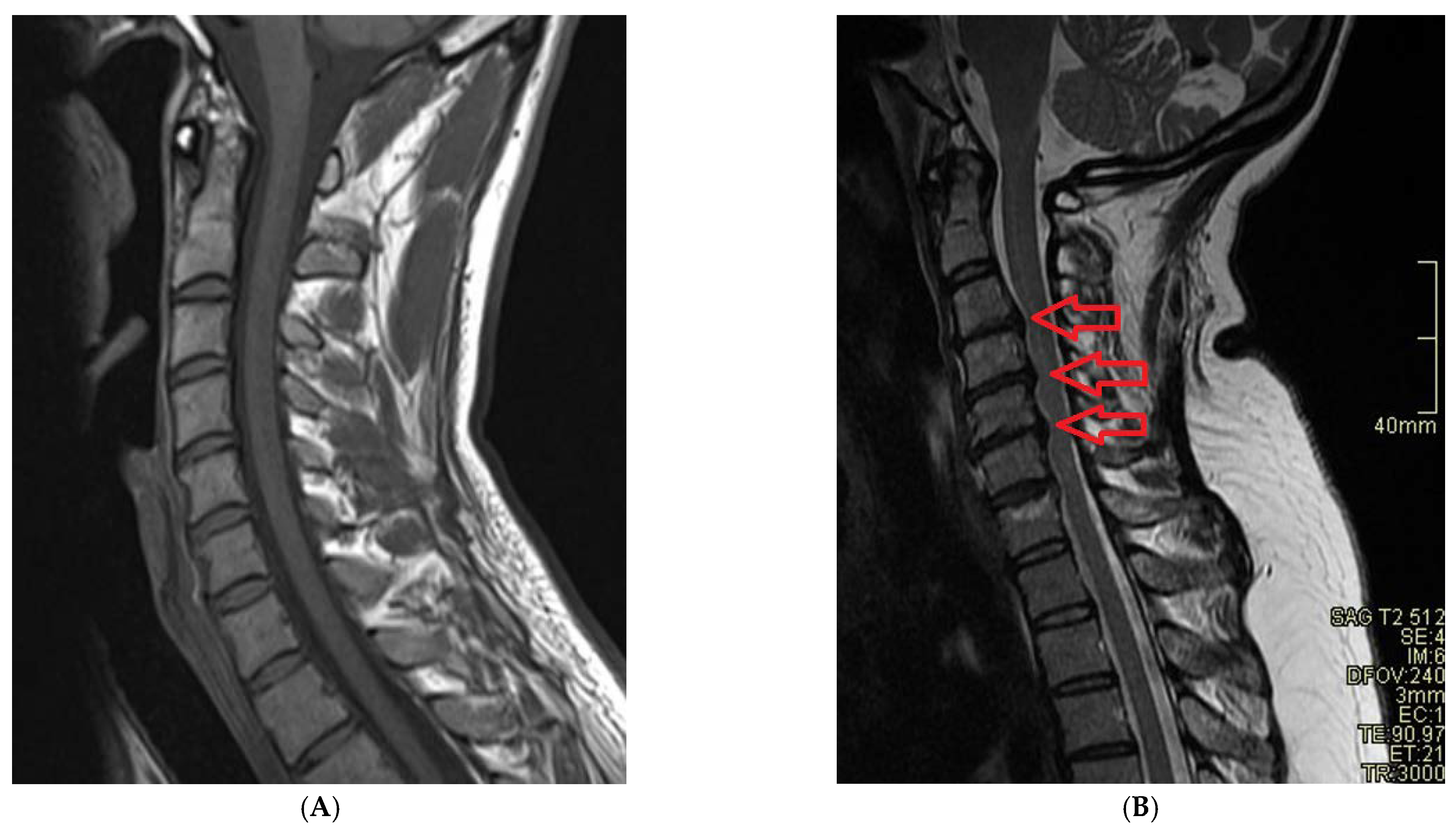 Cervical Spine Mri Comparison