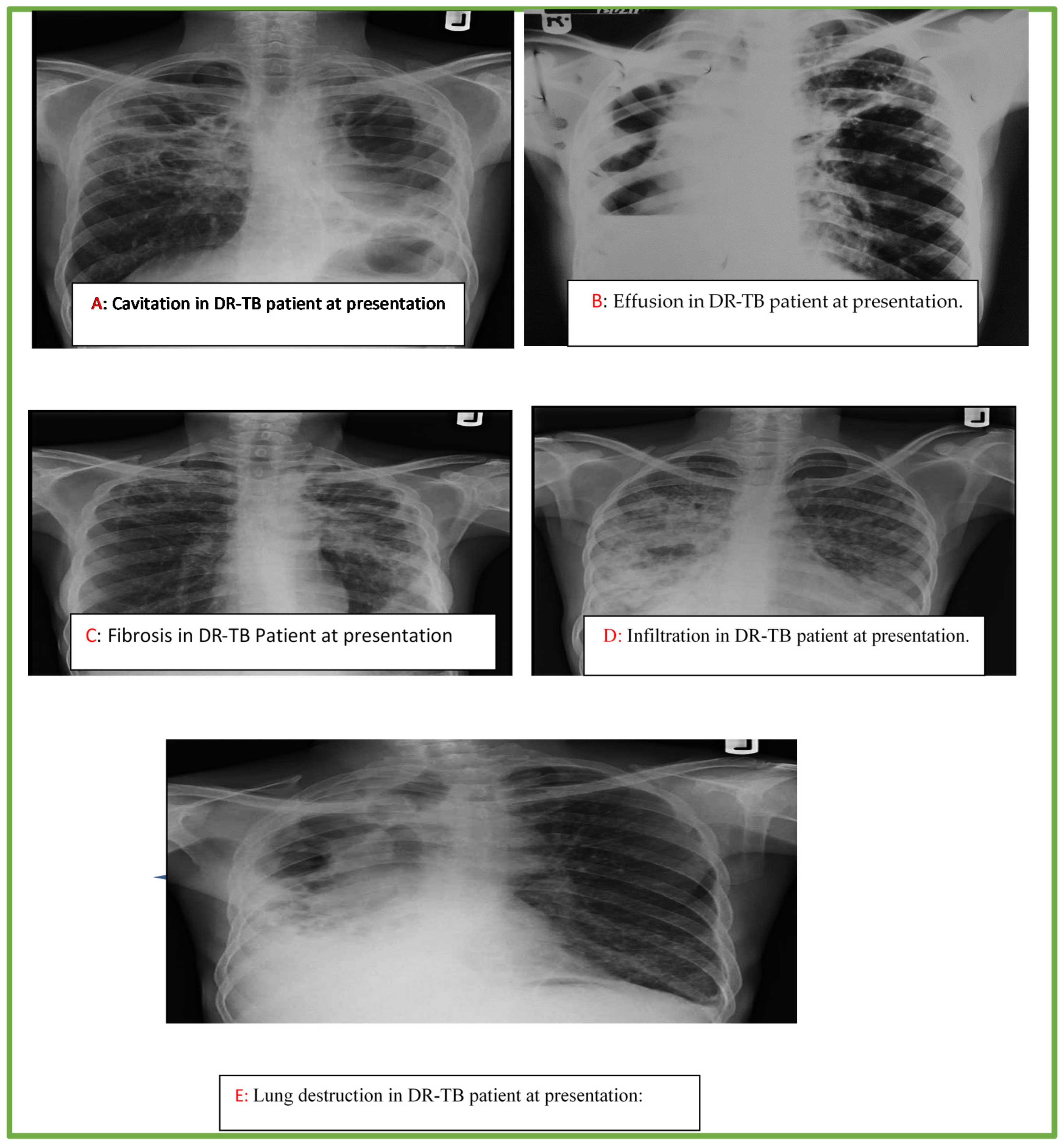 Example of patient with chest wall asymmetry. (A) Patient's