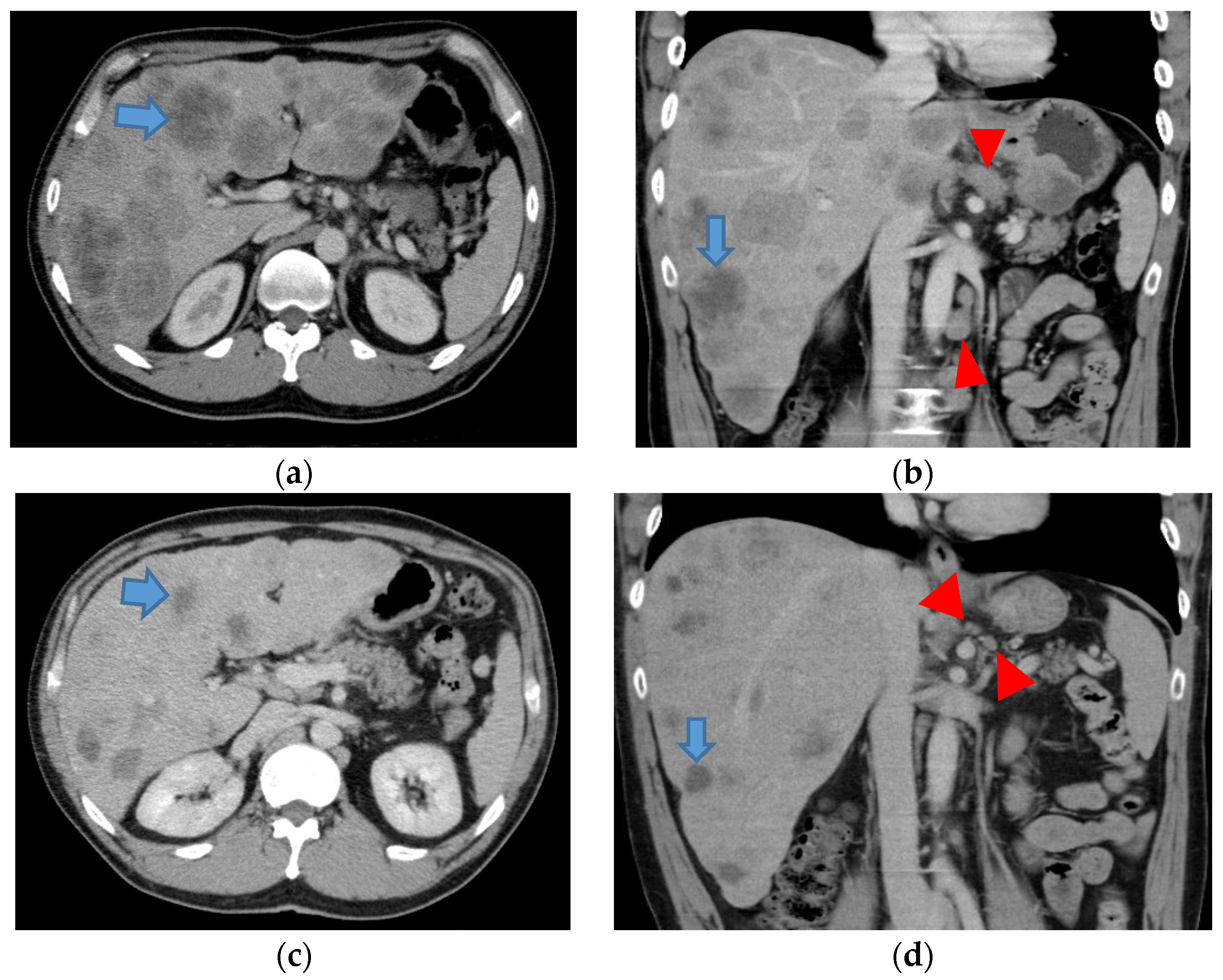 Where do liver metastases come from? Where do liver metastases come from?
