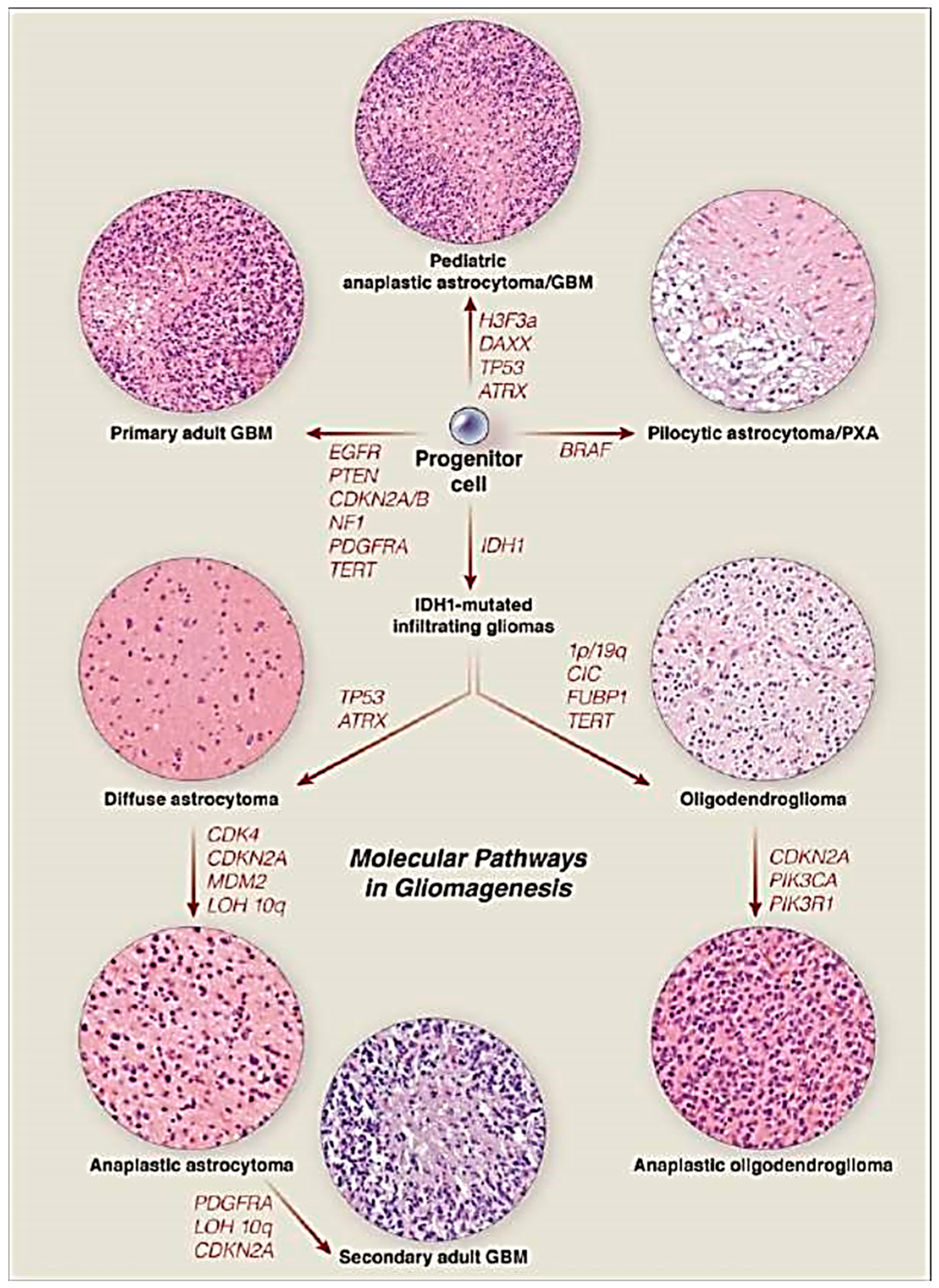 picture Clear Cell Ependymoma Pathology Outlines disparities in brain cancer in the
