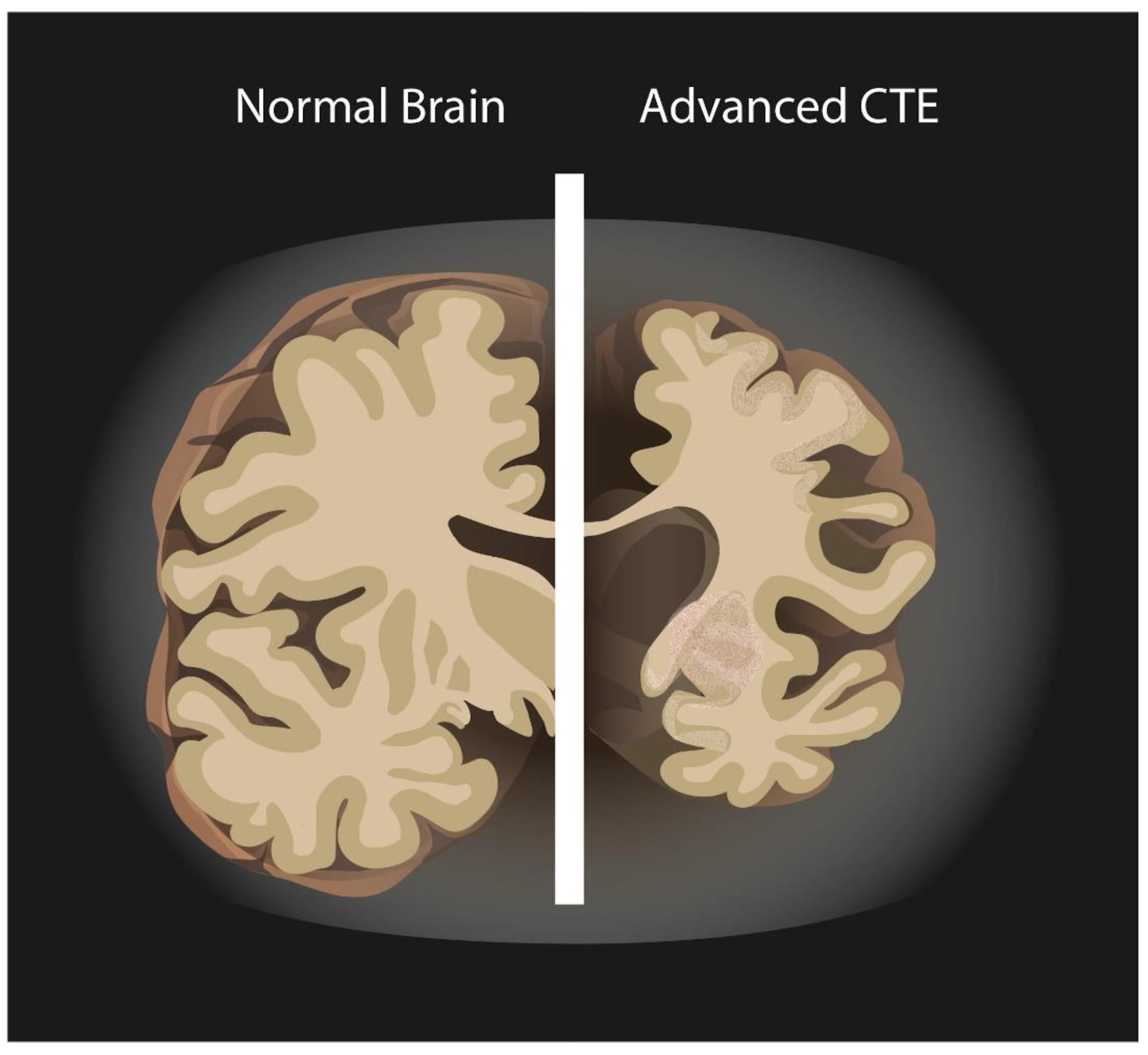 Concussion Brain Compared To Normal