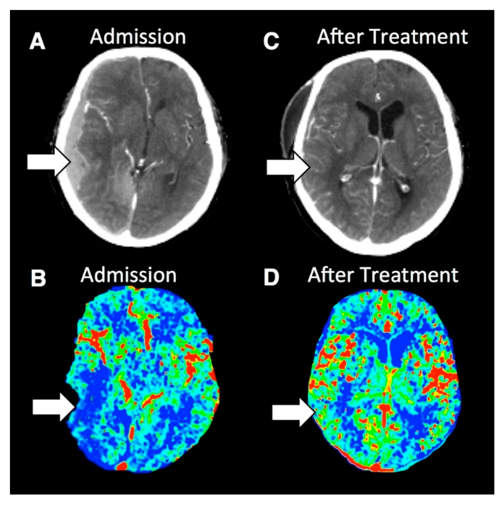 Extra axial hemorrhage