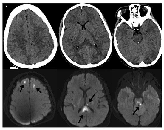 Magnetic resonance imaging. Large intracranial hemorrhage with moderate