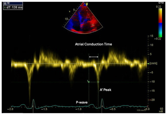 tirzepatide atrial fibrillation Epicardial Adipose Tissue as a Cardiometabolic Target in Atrial Fibrillation:  Implications for Ablation Strategies and Emerging Metabolic Therapies
