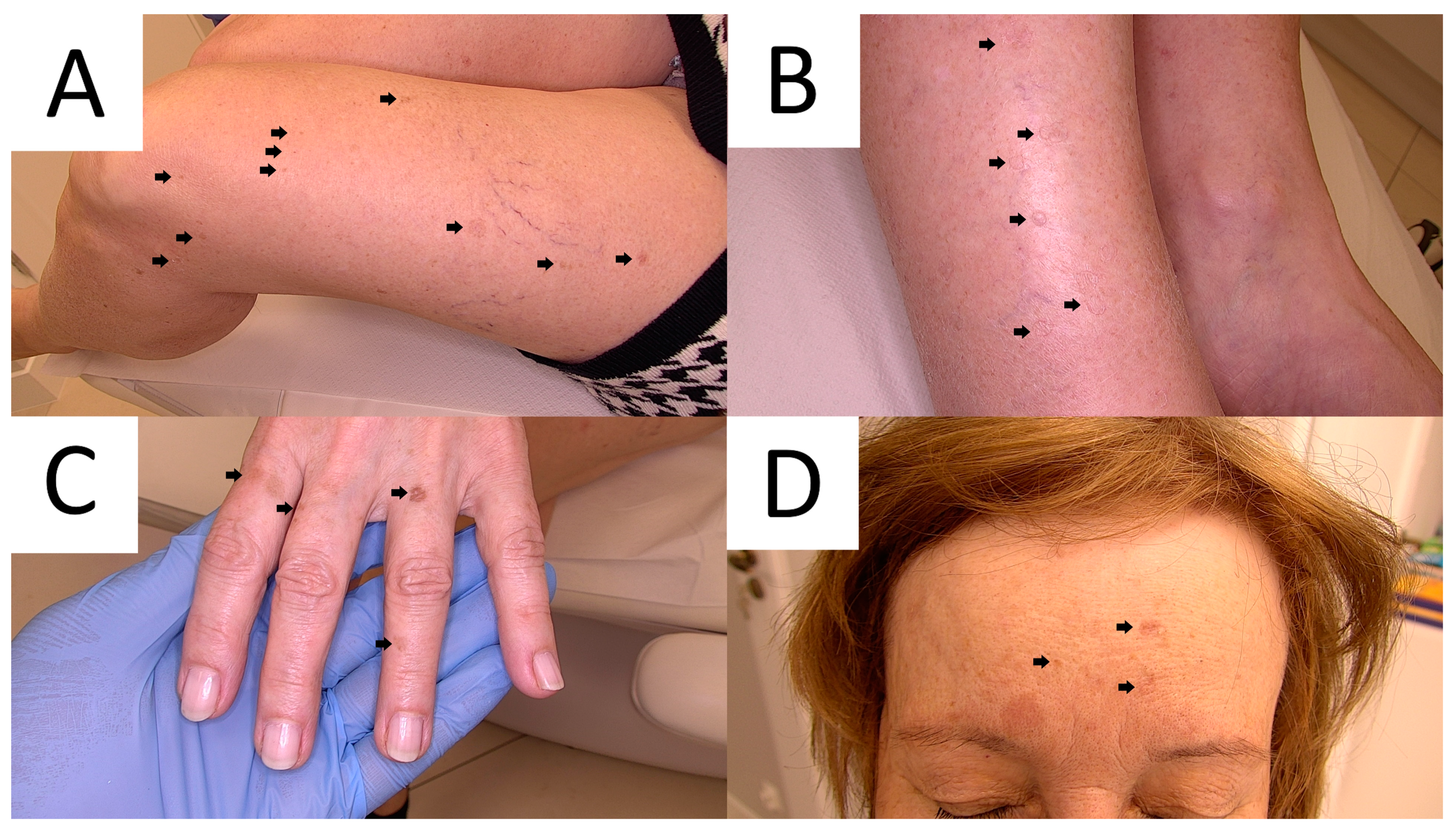 Lichen striatus with nail dystrophy in an infant]. | Semantic Scholar