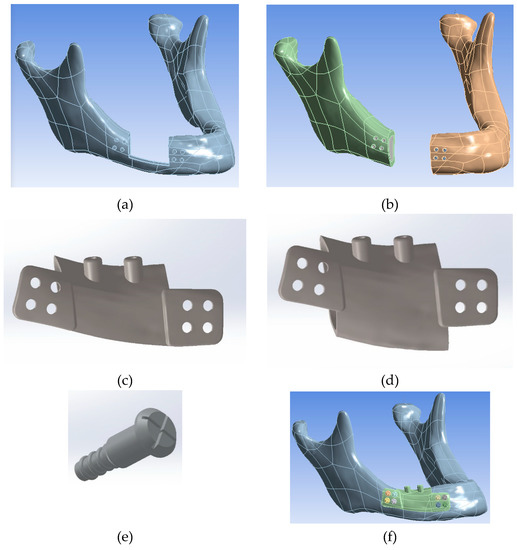 Metals Free FullText Biomechanical Assessment of Design Parameters