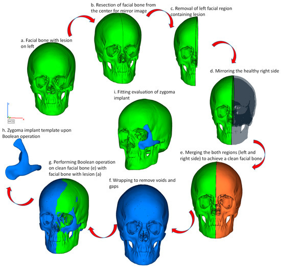 Metals | Free Full-Text | Reconstruction of Complex Zygomatic Bone